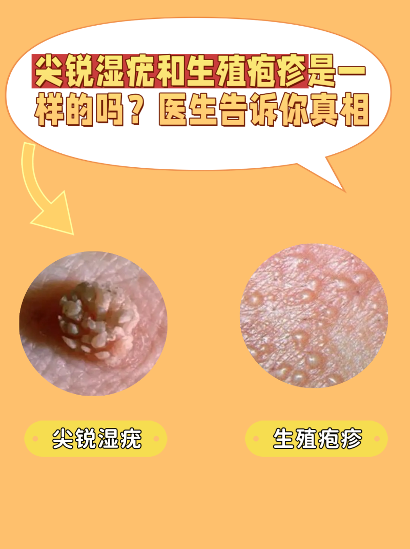 私密部位长了"小疙瘩",不少人分不清是尖锐湿疣还是