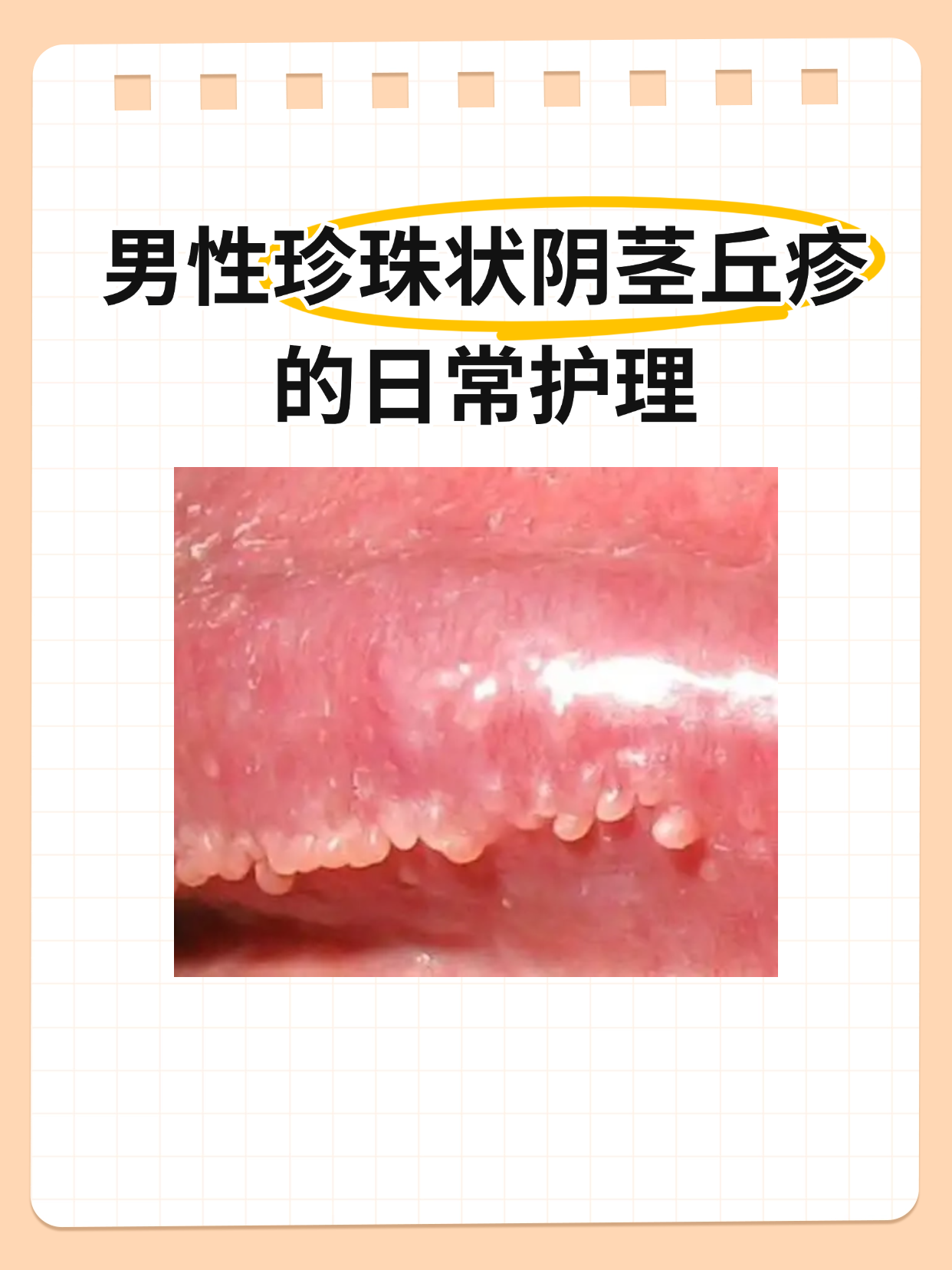男性珍珠状阴茎丘疹的日常护理