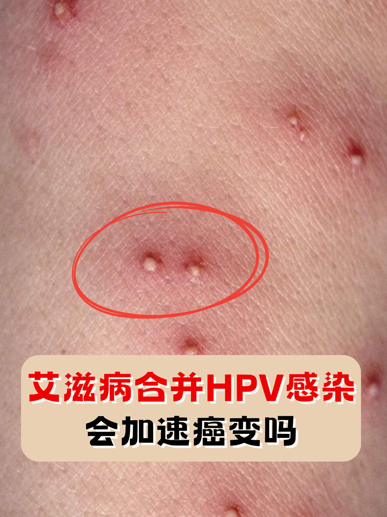  hsv病毒是什么意思二型(hsv2型病毒是怎么感染的)