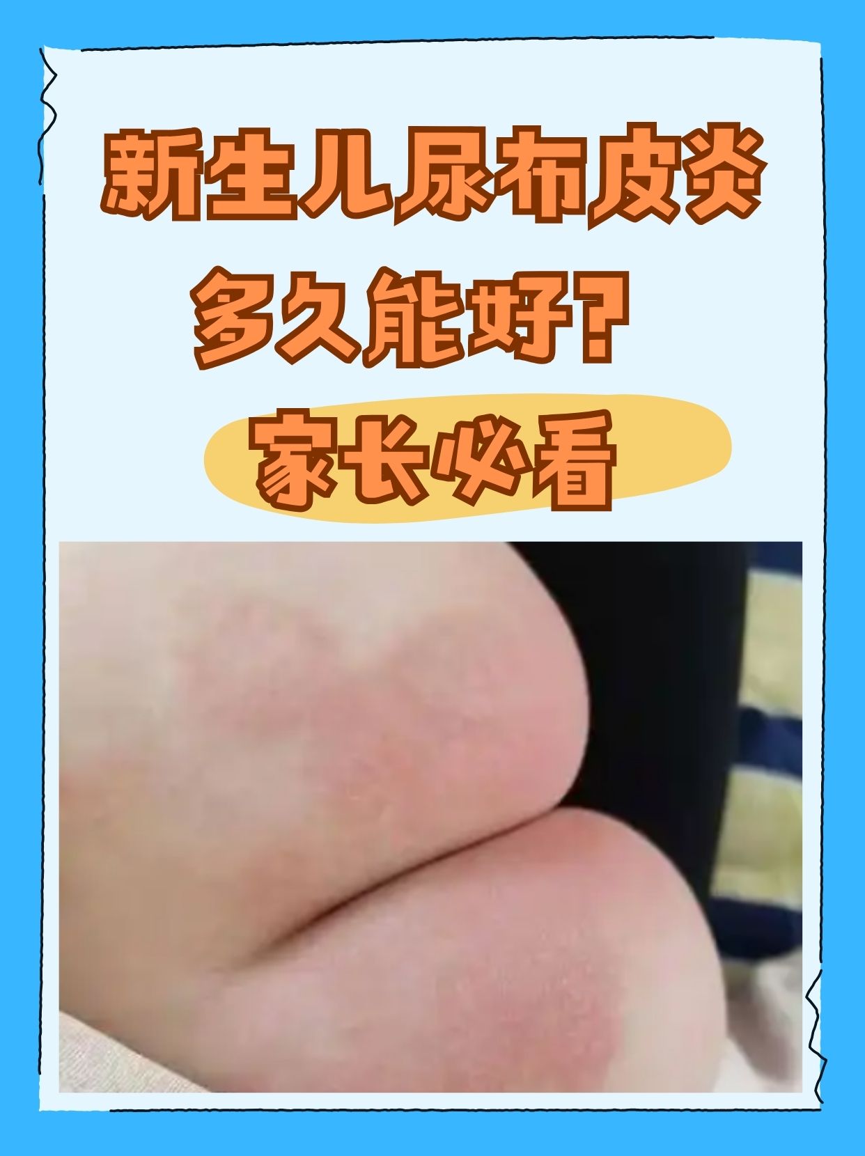 新生儿尿布皮炎多久能好?