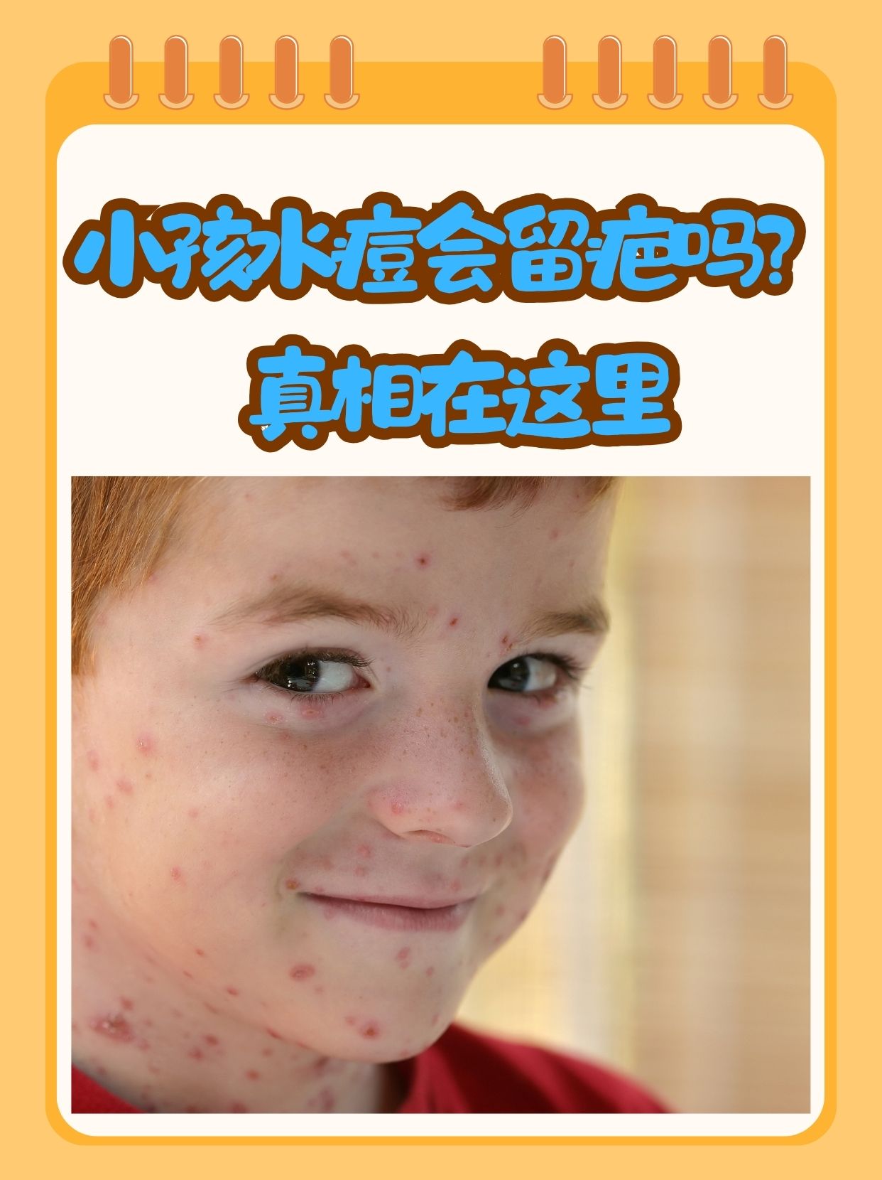  小孩最近流行什么病毒引起2020(现在小孩流行的什么病毒感染)
