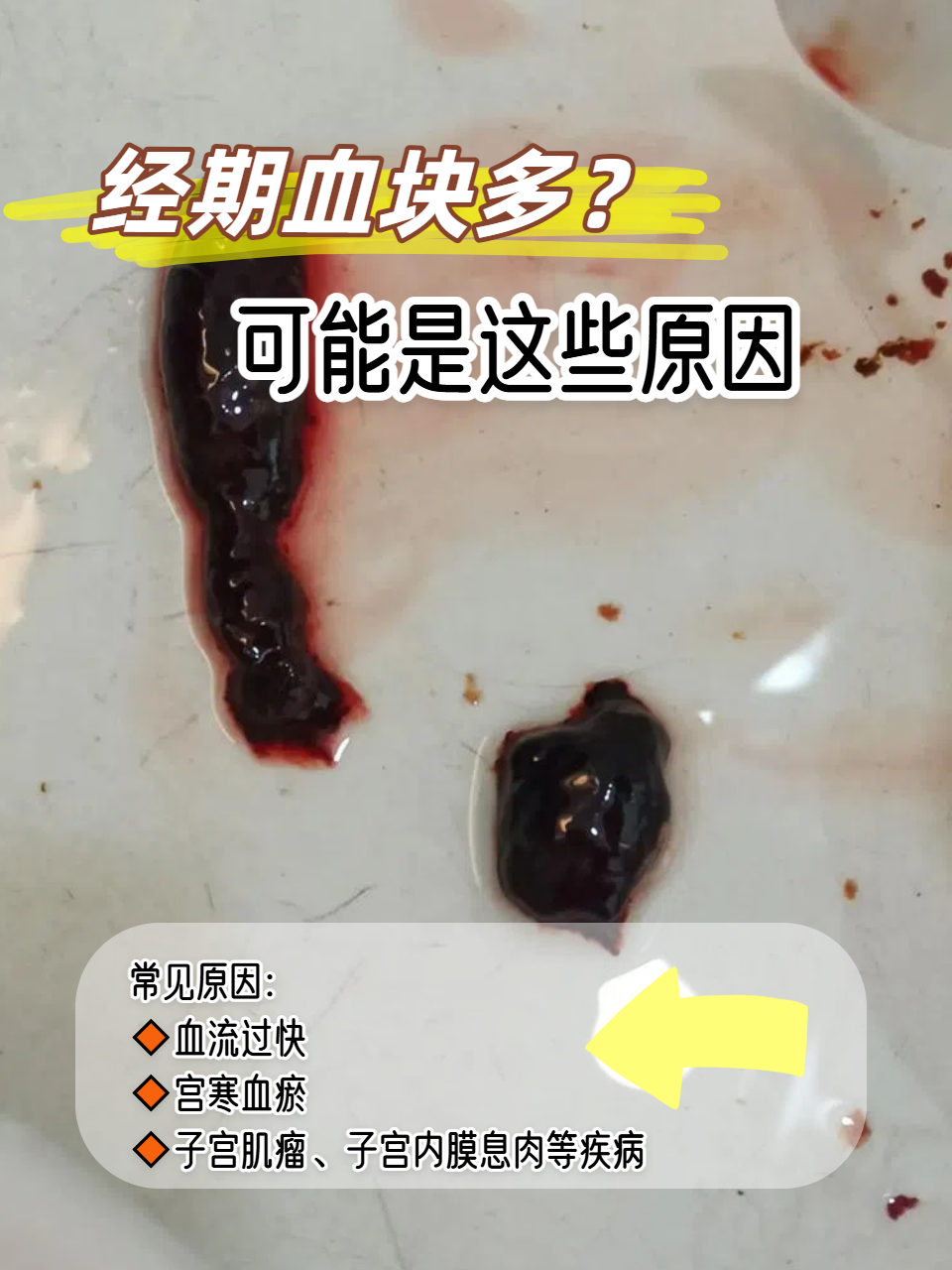 血块多的常见原因: 血流过快:月经量多时经血来不