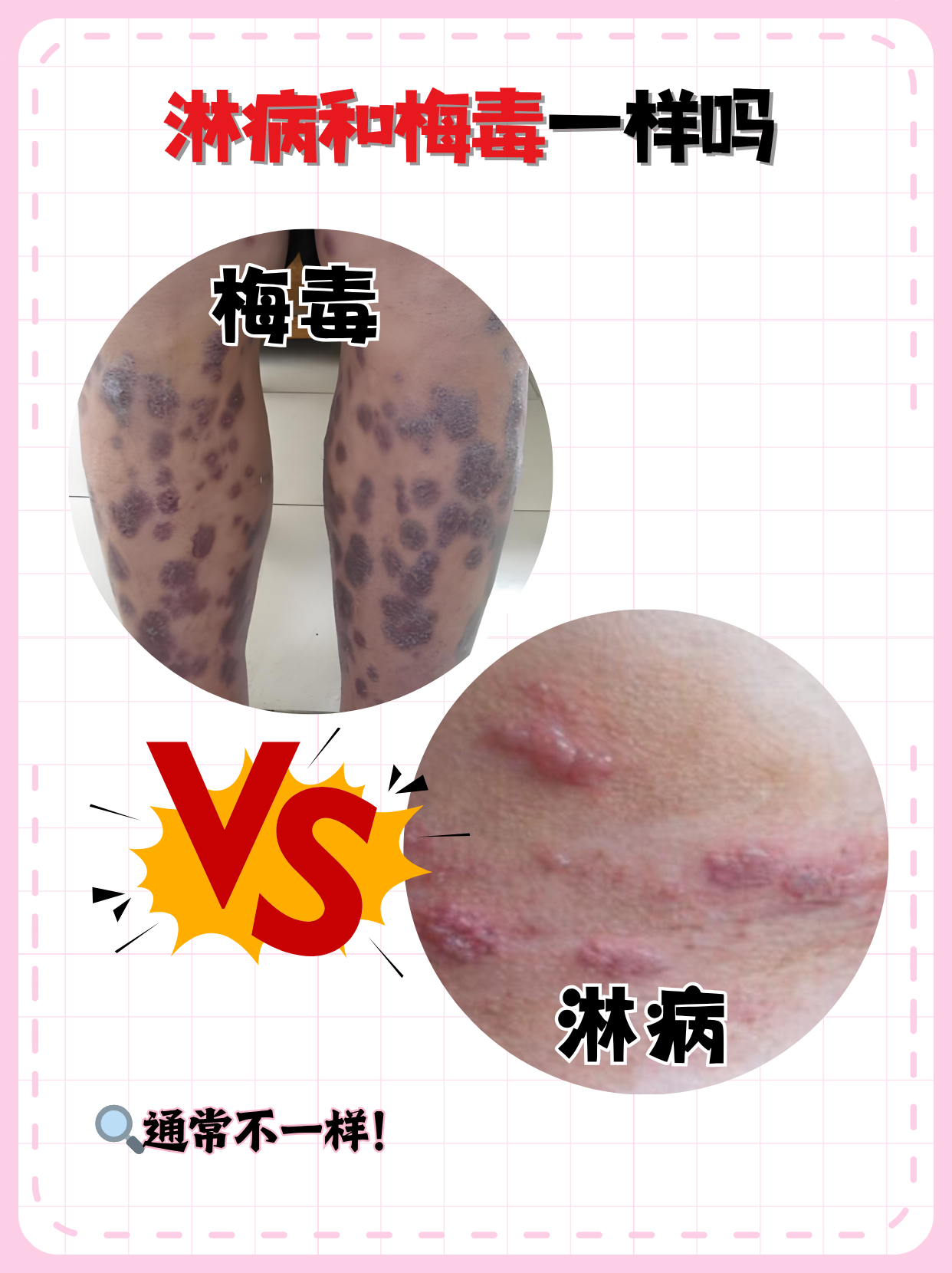 可能侵犯全身器官男性得了淋病早期图片淋病的症状是什么样男性梅毒