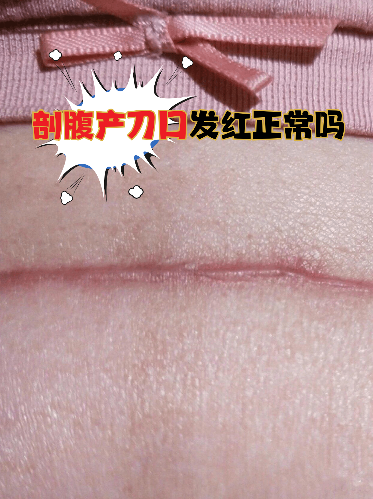 剖腹产刀口发红正常吗