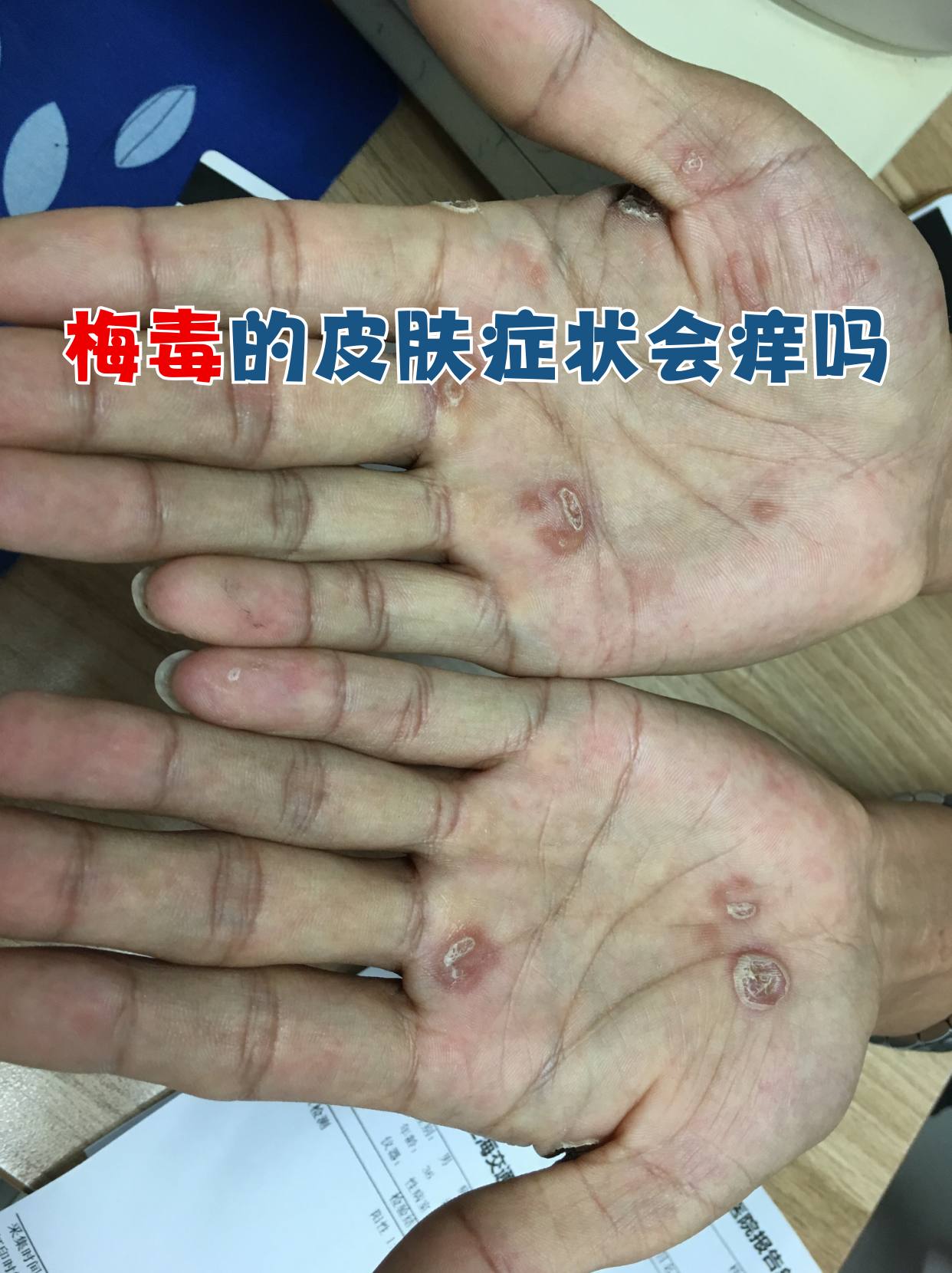 梅毒皮肤症状特点 无痛性硬下疳:一