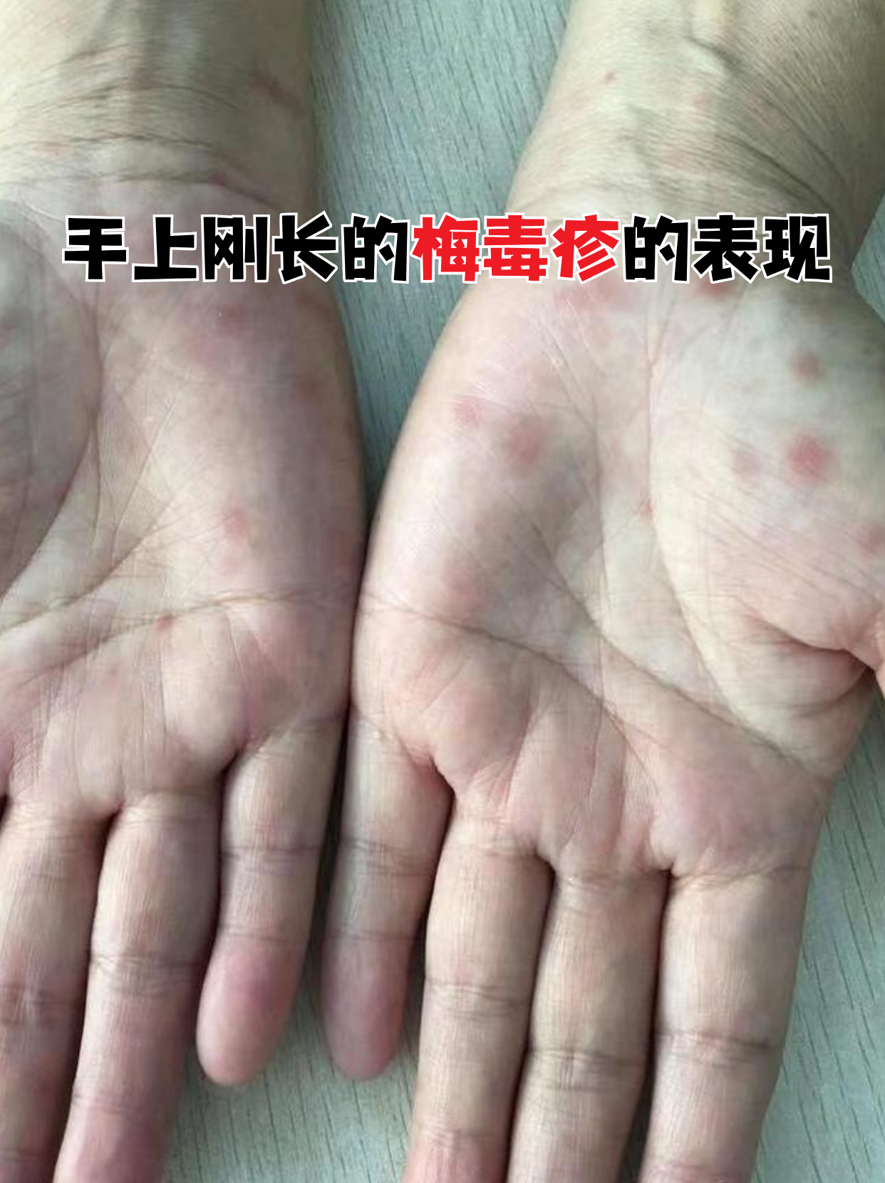 手上刚长的梅毒疹的表现