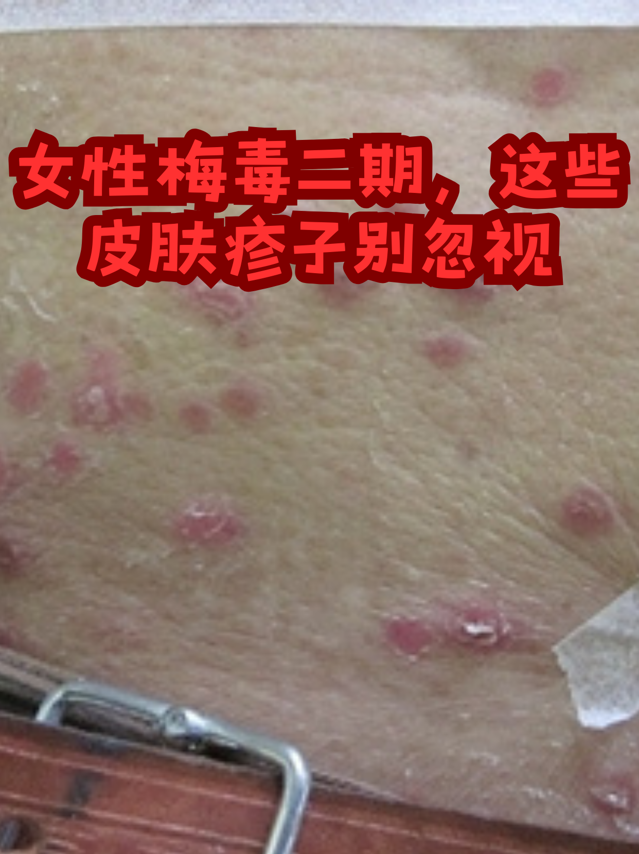 女性梅毒二期,这些皮肤疹子别忽视