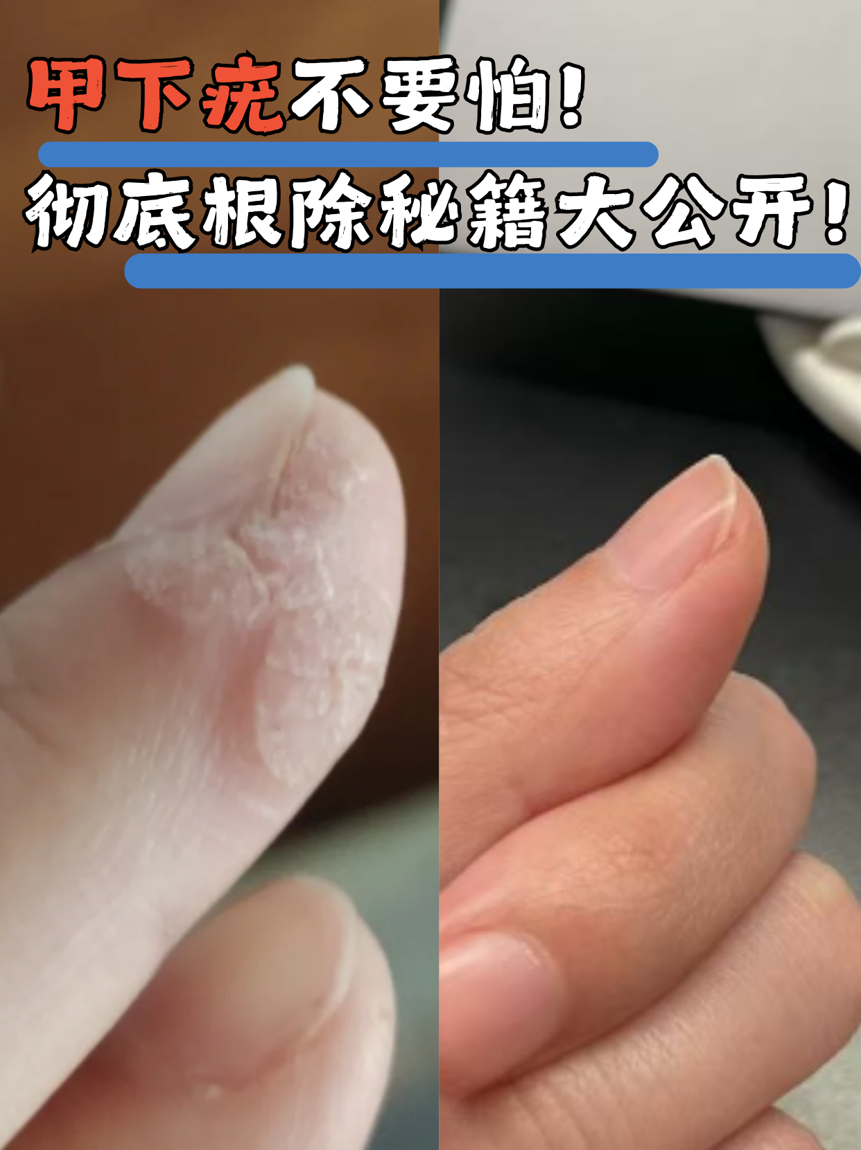 甲下疣,作为长在指甲下面的寻常疣,会给患者带来