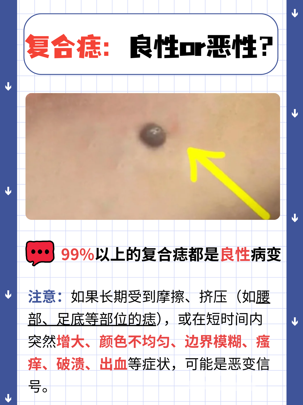 复合痣是一种皮肤病变,它是皮内痣和交界痣的混合形式,由痣细胞在