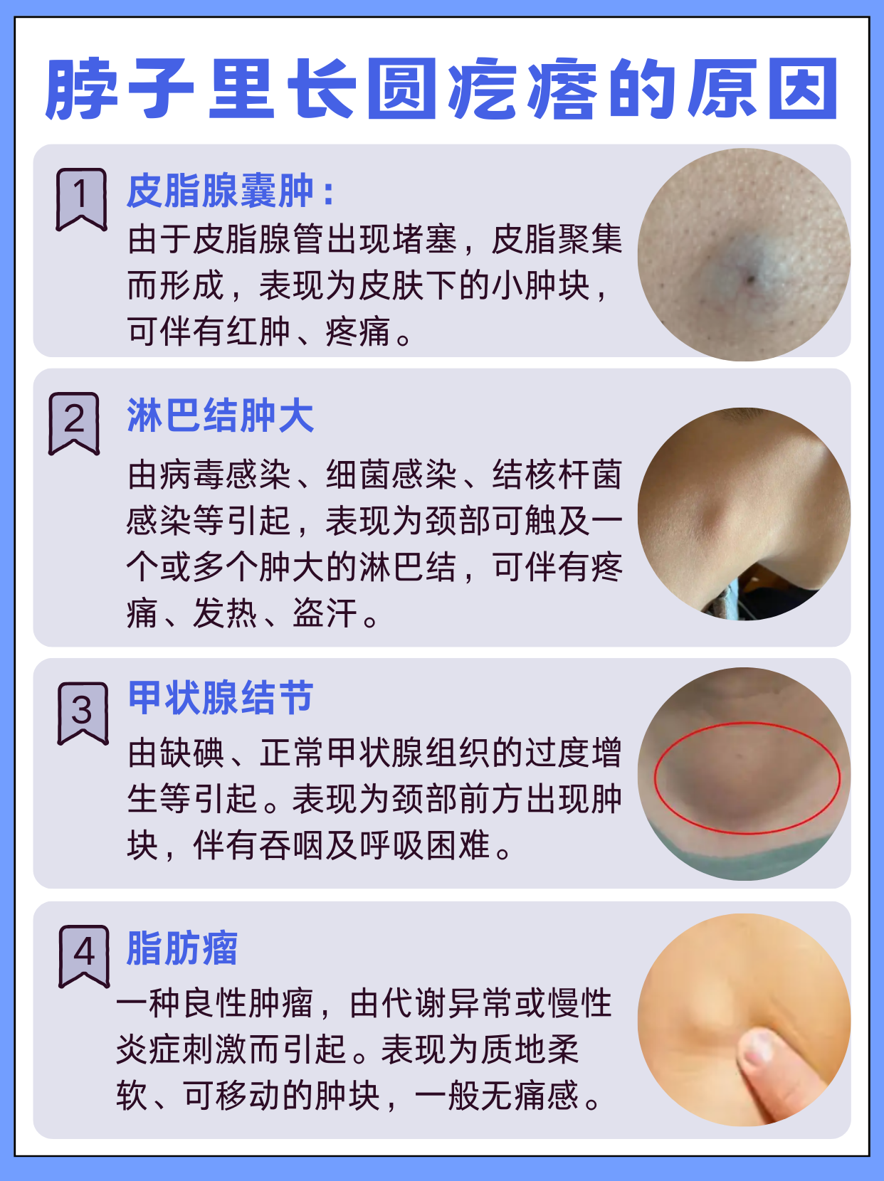 出现无意间摸到脖子里一个圆疙瘩的情况,可能是皮脂腺囊肿,淋巴结