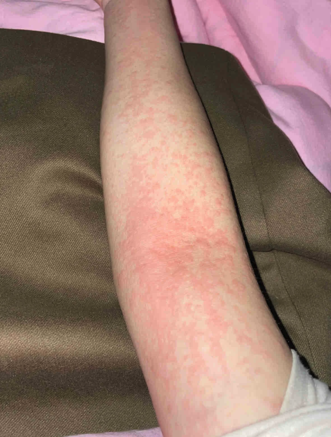 一冷身上就痒起疙瘩,这种情况可能与多种原因有关: