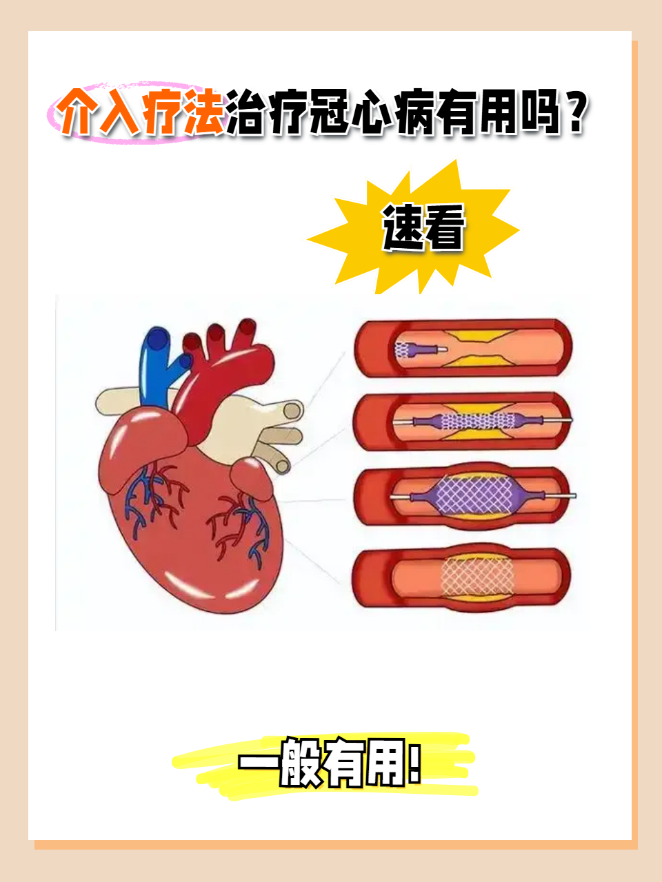 冠心病治疗