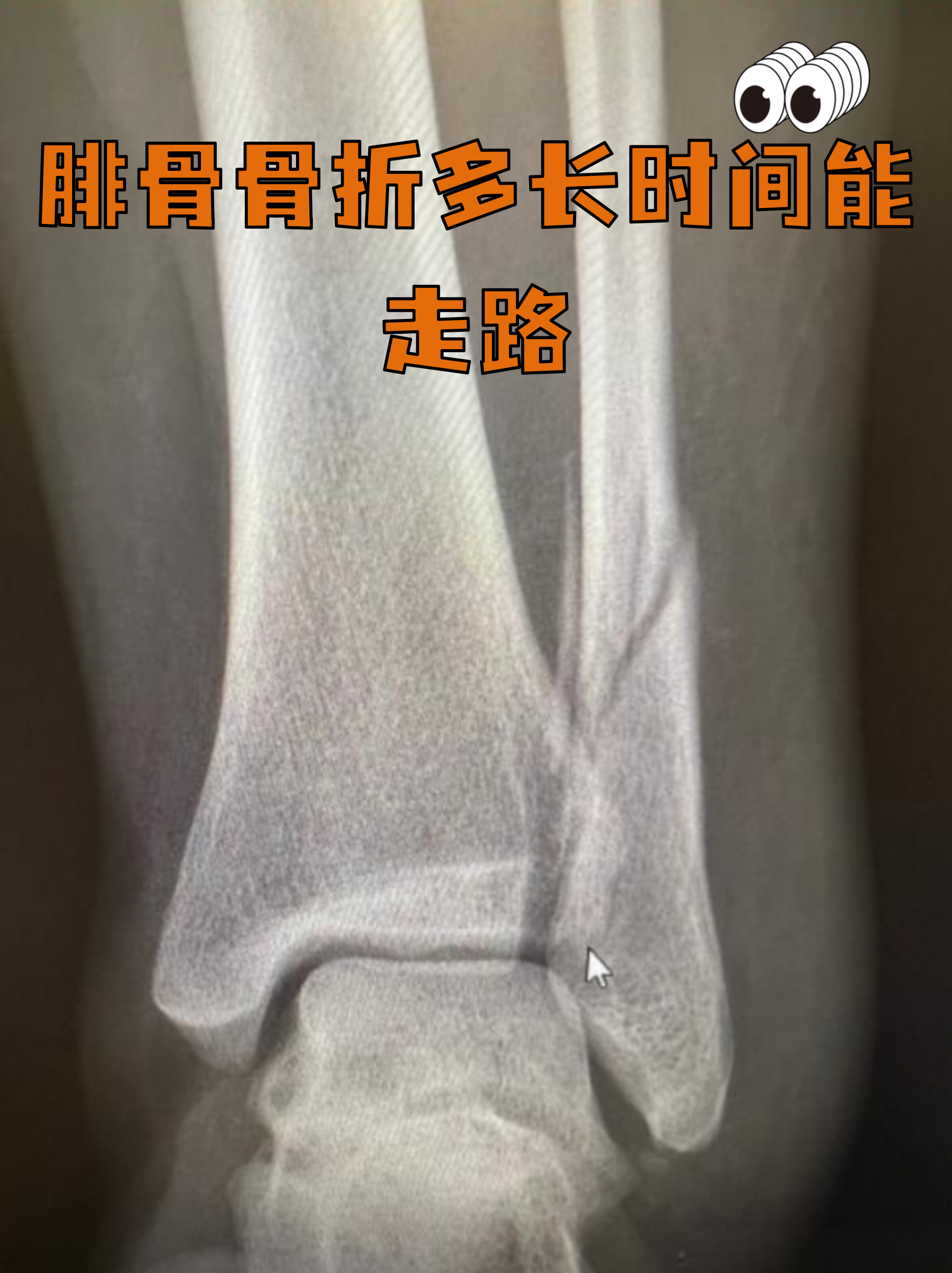 安贞医院代取报告代挂号术后康复全程跟踪,恢复不走弯路的简单介绍 安贞医院代取报告代挂号术后康复全程跟踪,恢复不走弯路的简单介绍