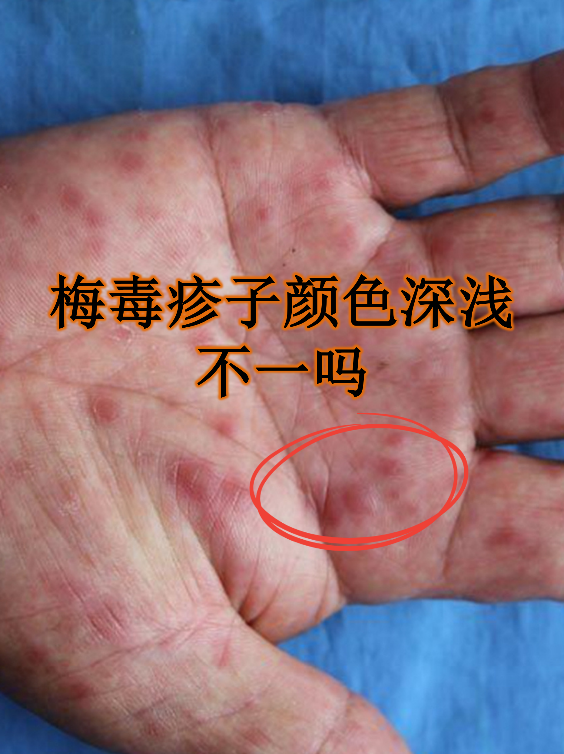 梅毒疹子颜色深浅不一吗