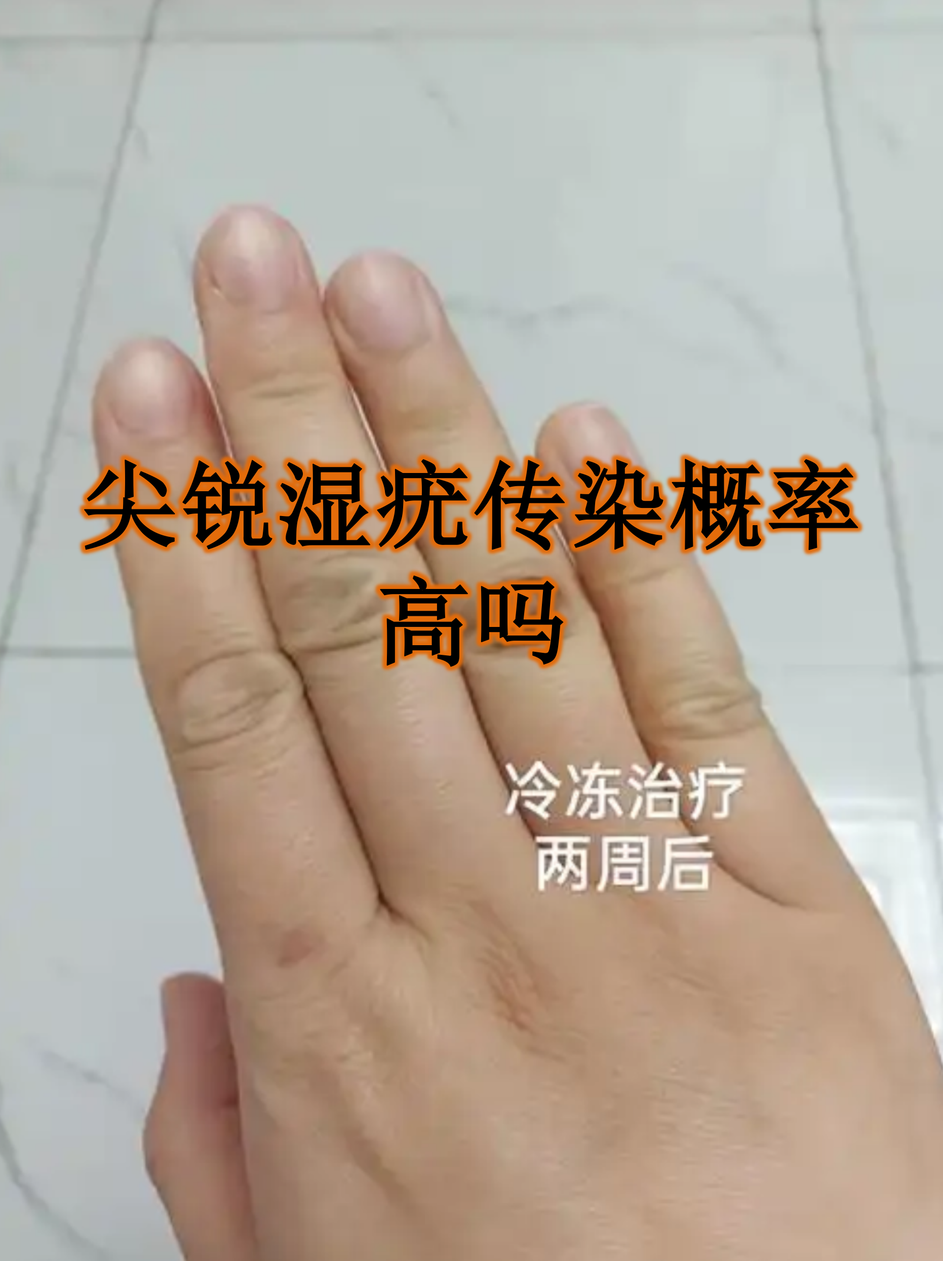 尖锐疣体变黑是为什么