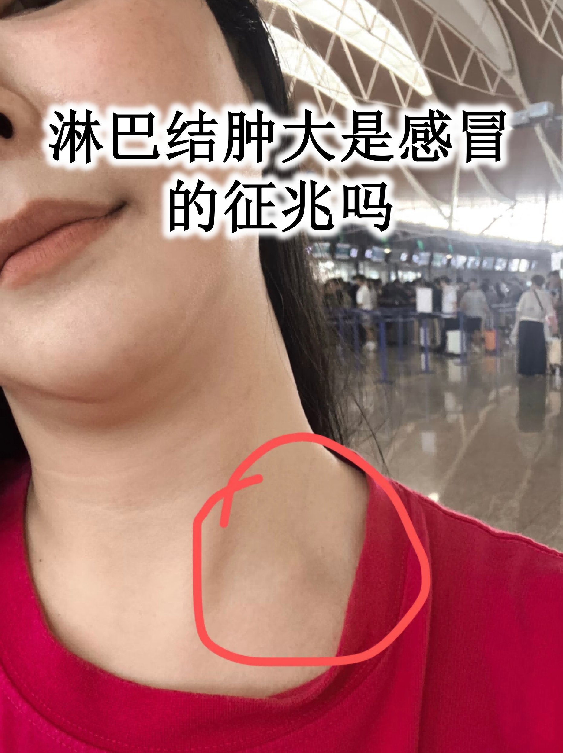 淋巴结肿大是感冒的征兆吗