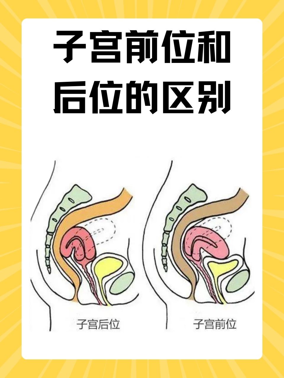在女性的生殖系统中,子宫作为孕育新生命的重要器官,其位置状态对