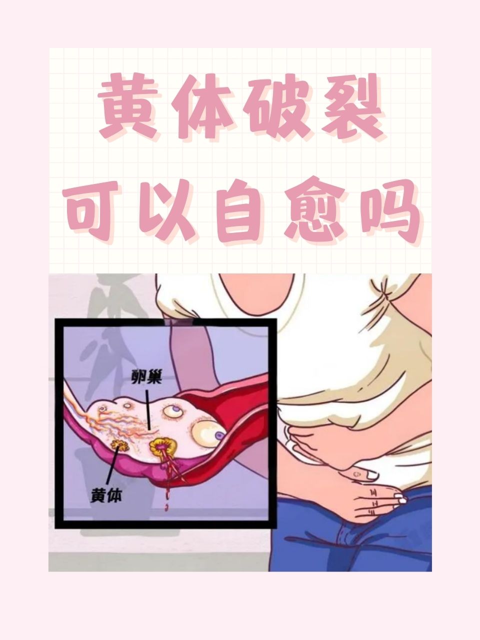 黄体破裂通常是黄体囊腔内压升高,凝血功能异常,剧烈运动