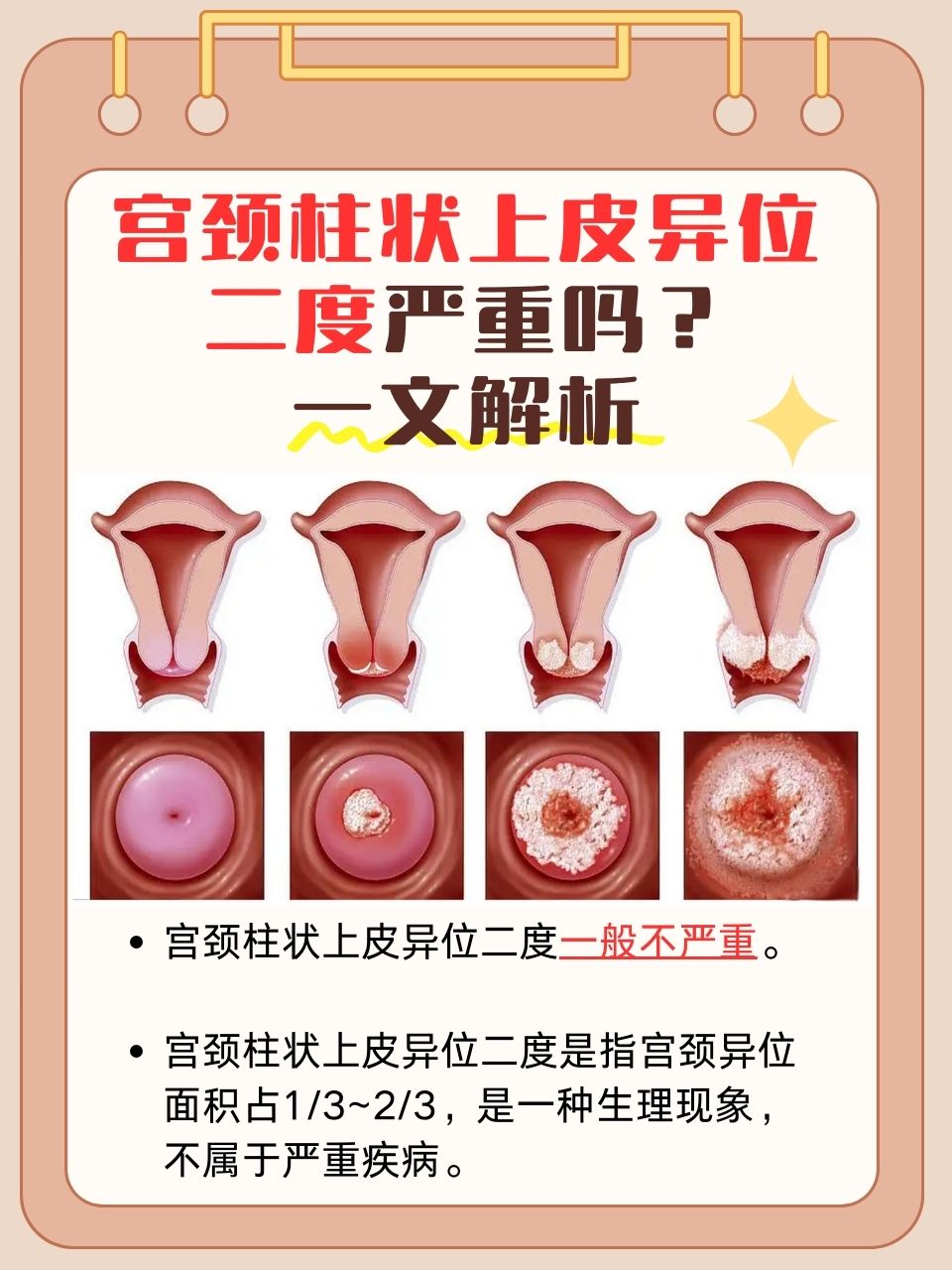 宫颈柱状上皮异位二度严重吗?