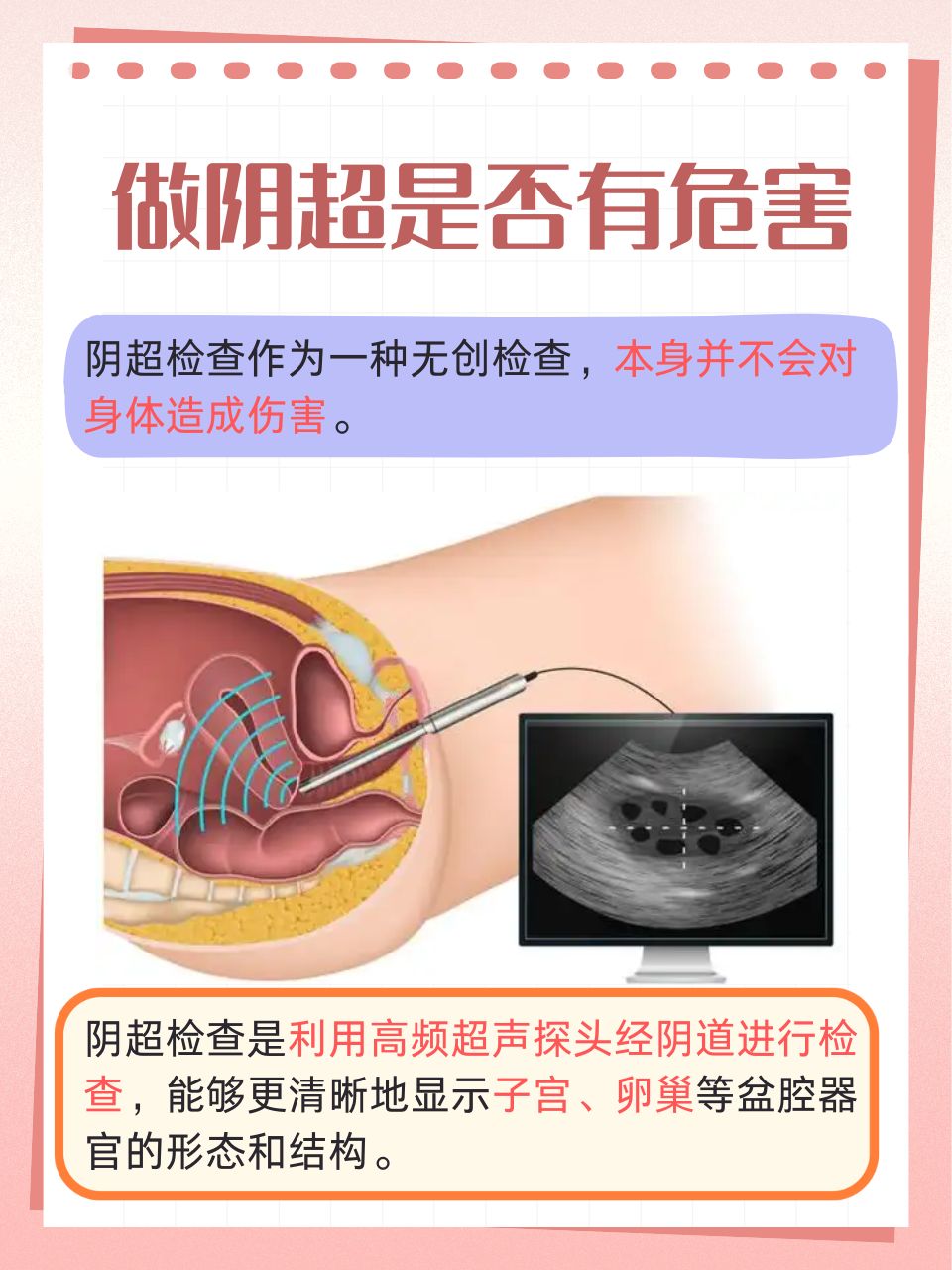在妇科检查的众多项目中,阴道b超(简称阴超)以其无创,准确的特点