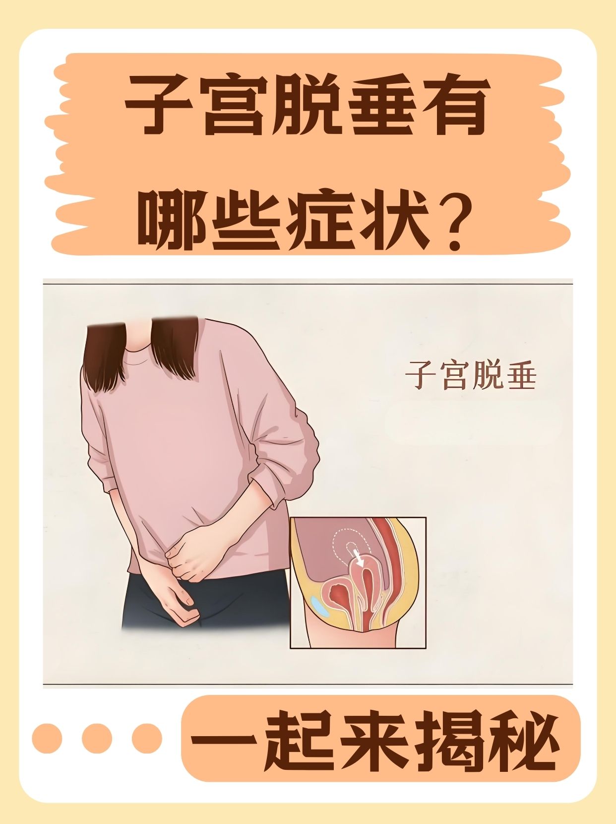 子宫脱垂有哪些症状?