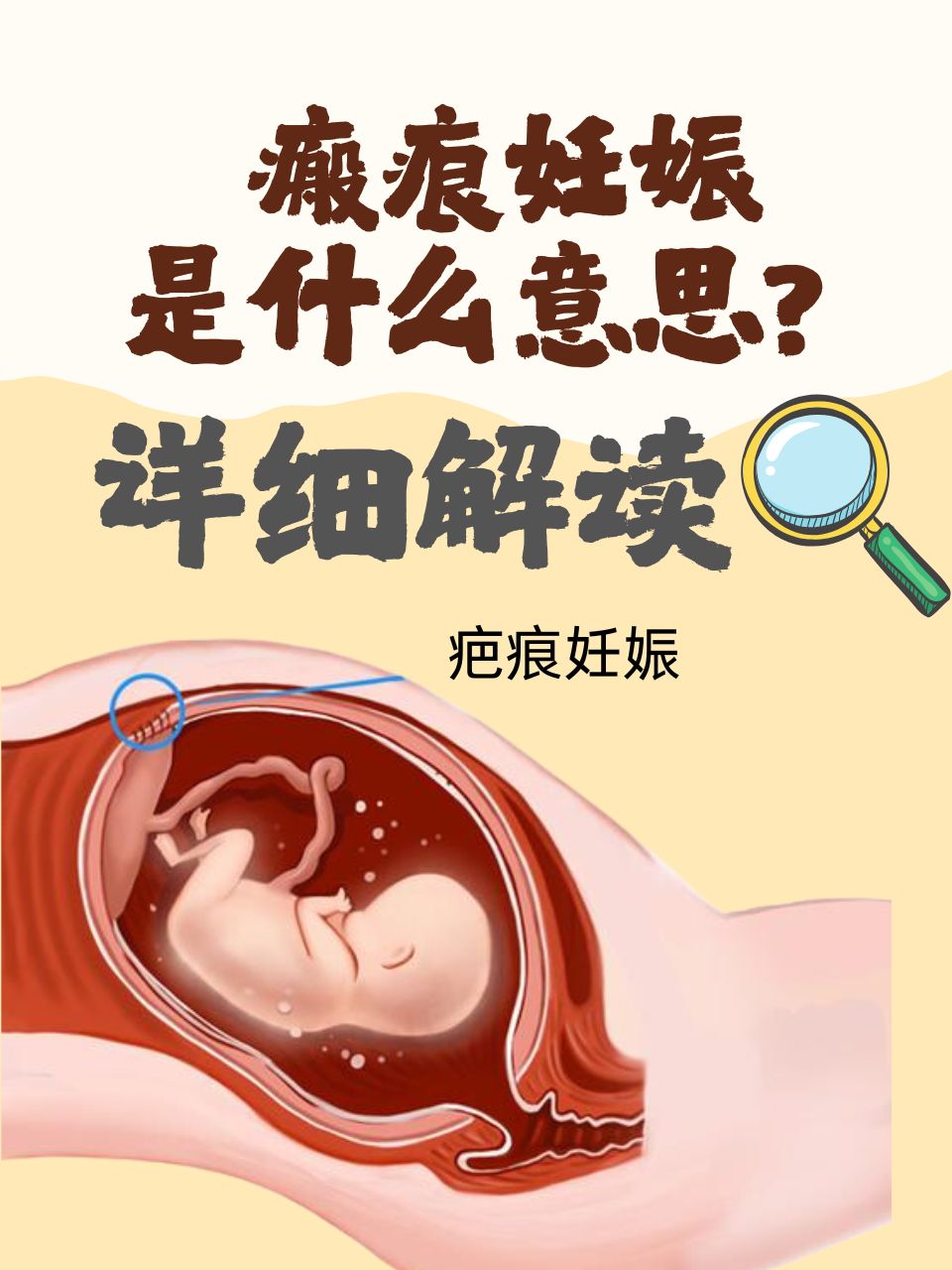 瘢痕妊娠是什么意思?