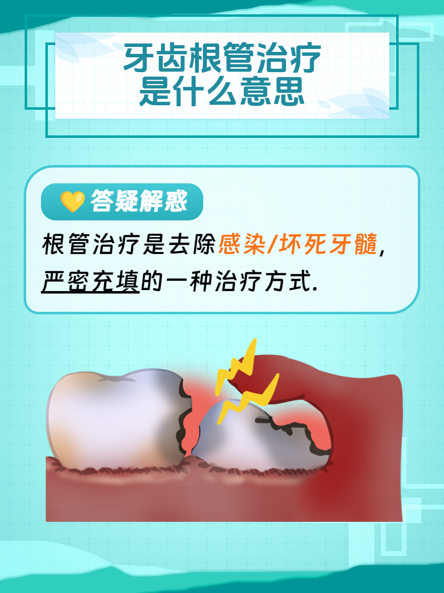 为什么根管治疗要做四五次百科在线 为什么根管治疗要做四五次百科在线