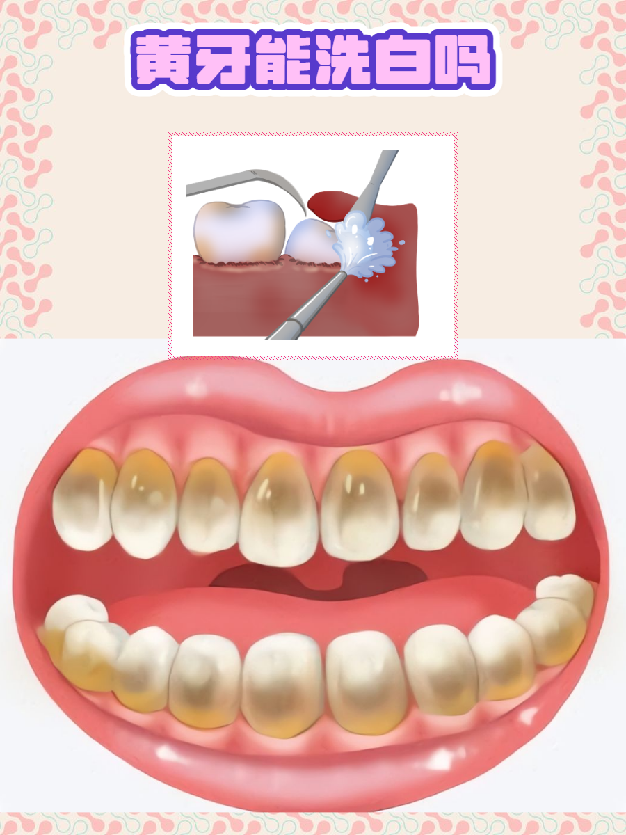 为什么牙齿会黄 为什么牙齿会黄