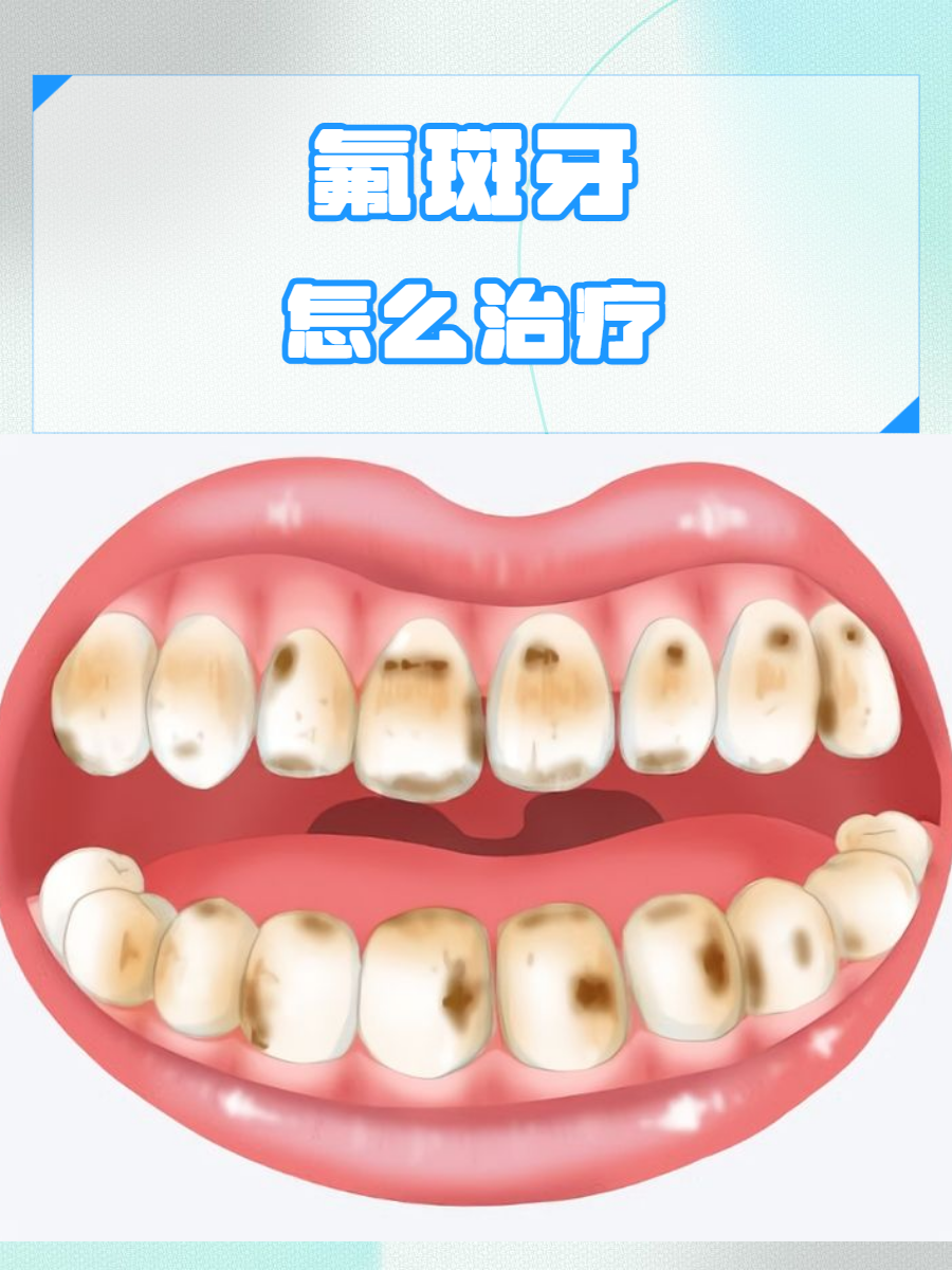 因为长期摄入过多的氟化物,导致牙齿表面出现白斑或棕黄色斑点的情况