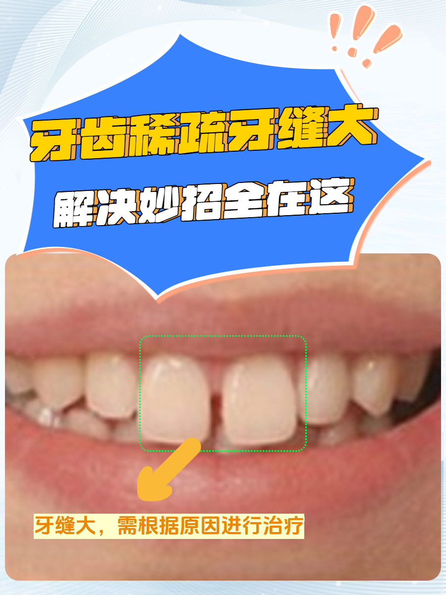 为什么牙齿缝隙越来越大