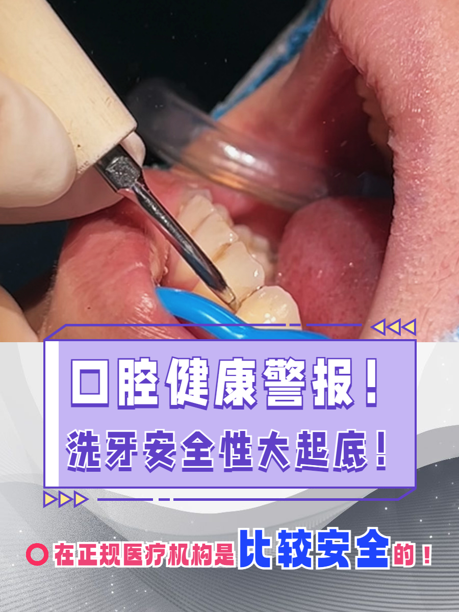 为什么洗牙要验血 为什么洗牙要验血