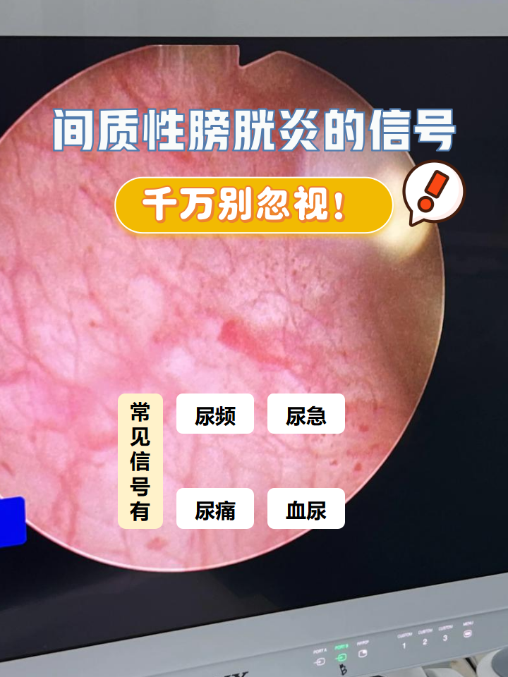 间质性膀胱炎
