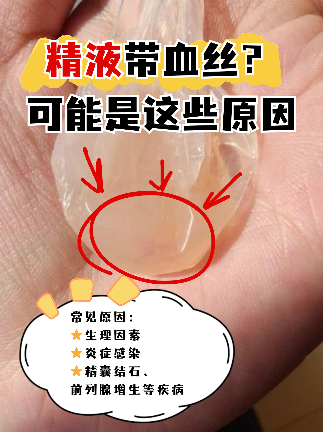 精液里出现血丝让人既担心又尴尬