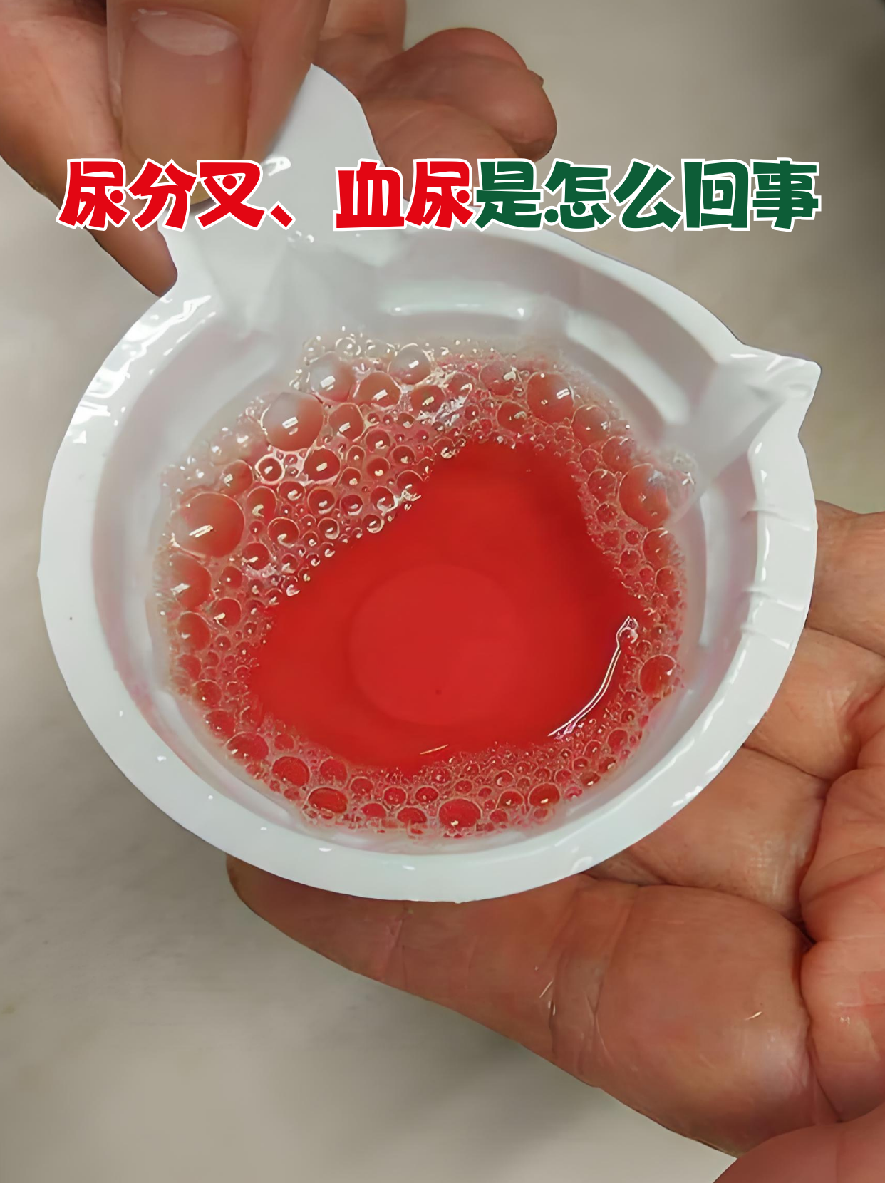 尿分叉,血尿是怎么回事