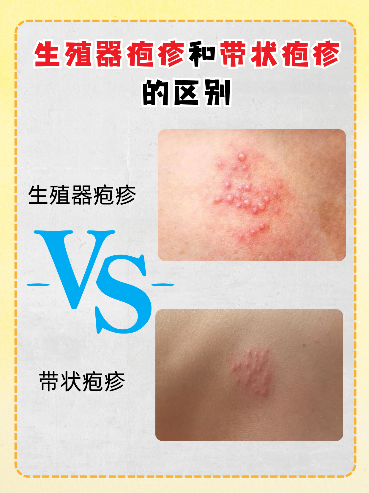 生殖器疱疹和带状疱疹的区别