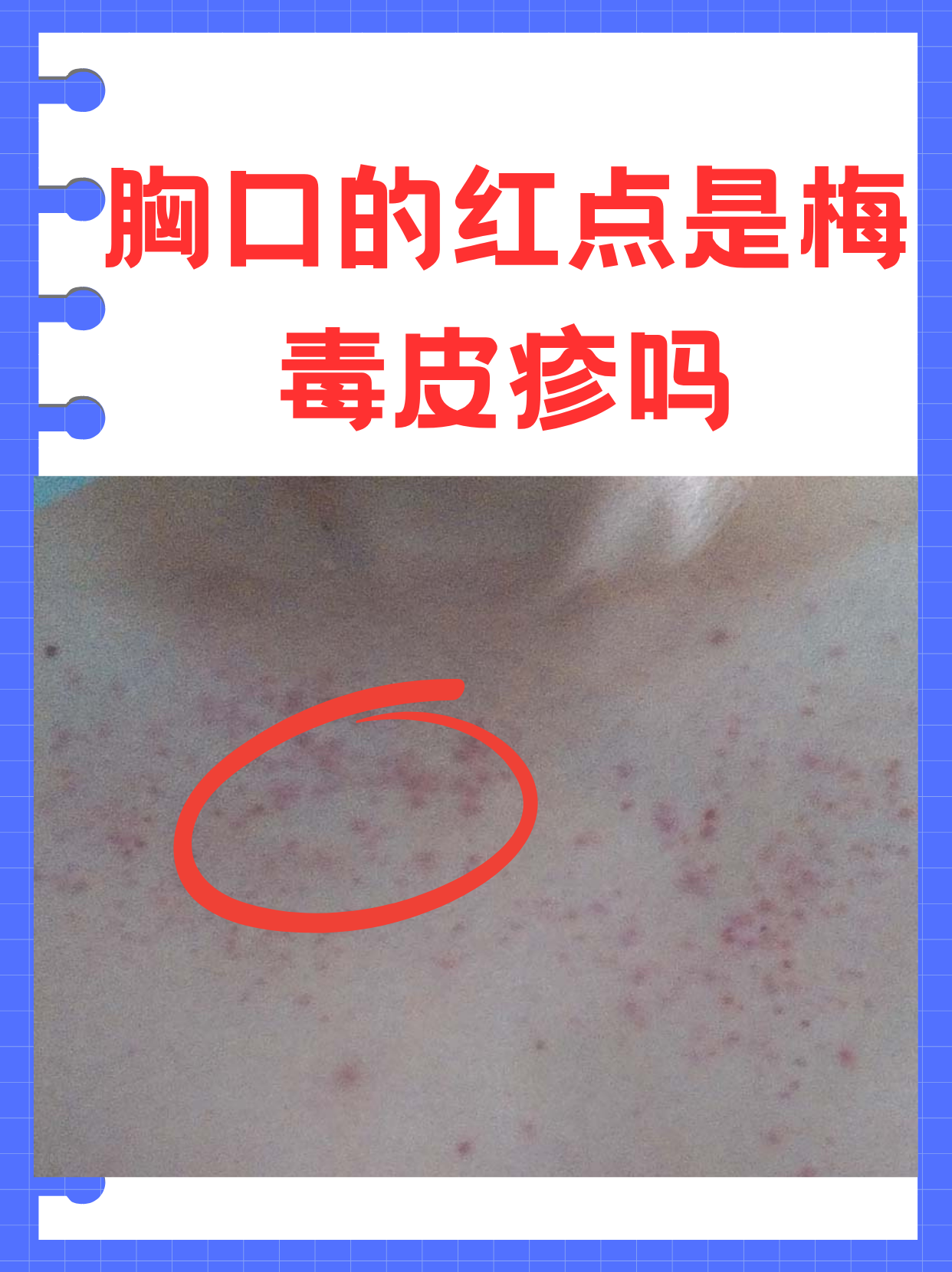 胸口的红点是梅毒皮疹吗