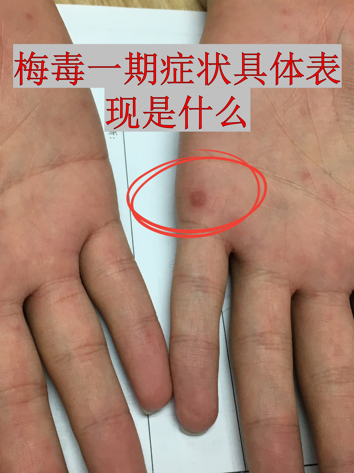 梅毒是由苍白螺旋体引起的性传播疾病,一期梅毒的症状往往容易被忽视