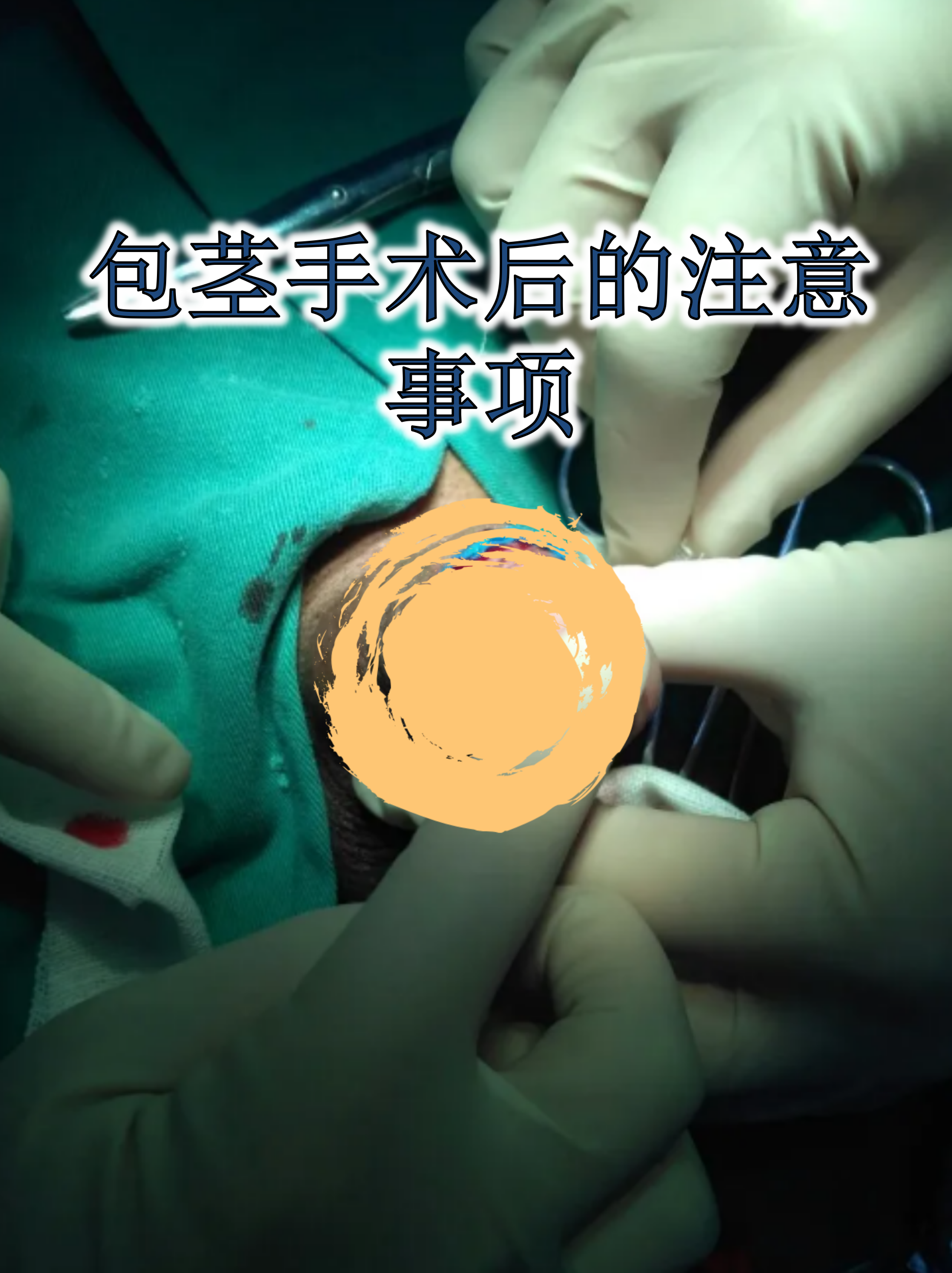 包茎手术后的注意事项