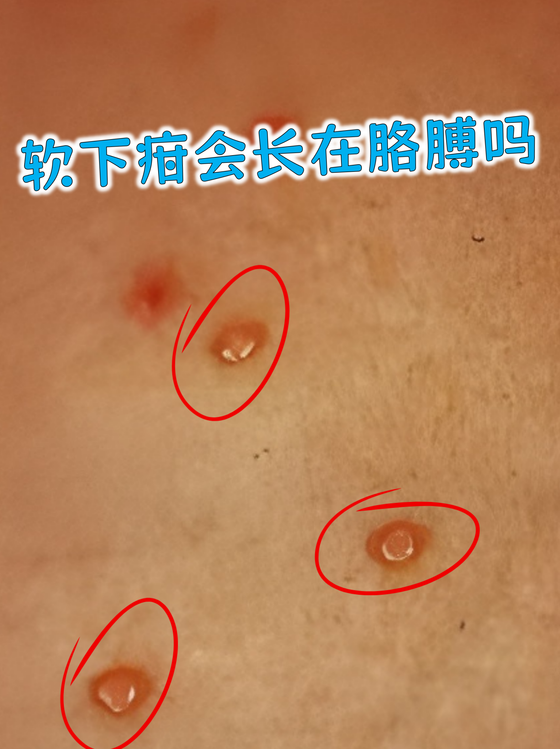 软下疳是一种性传播疾病,通常出现在生殖器区域