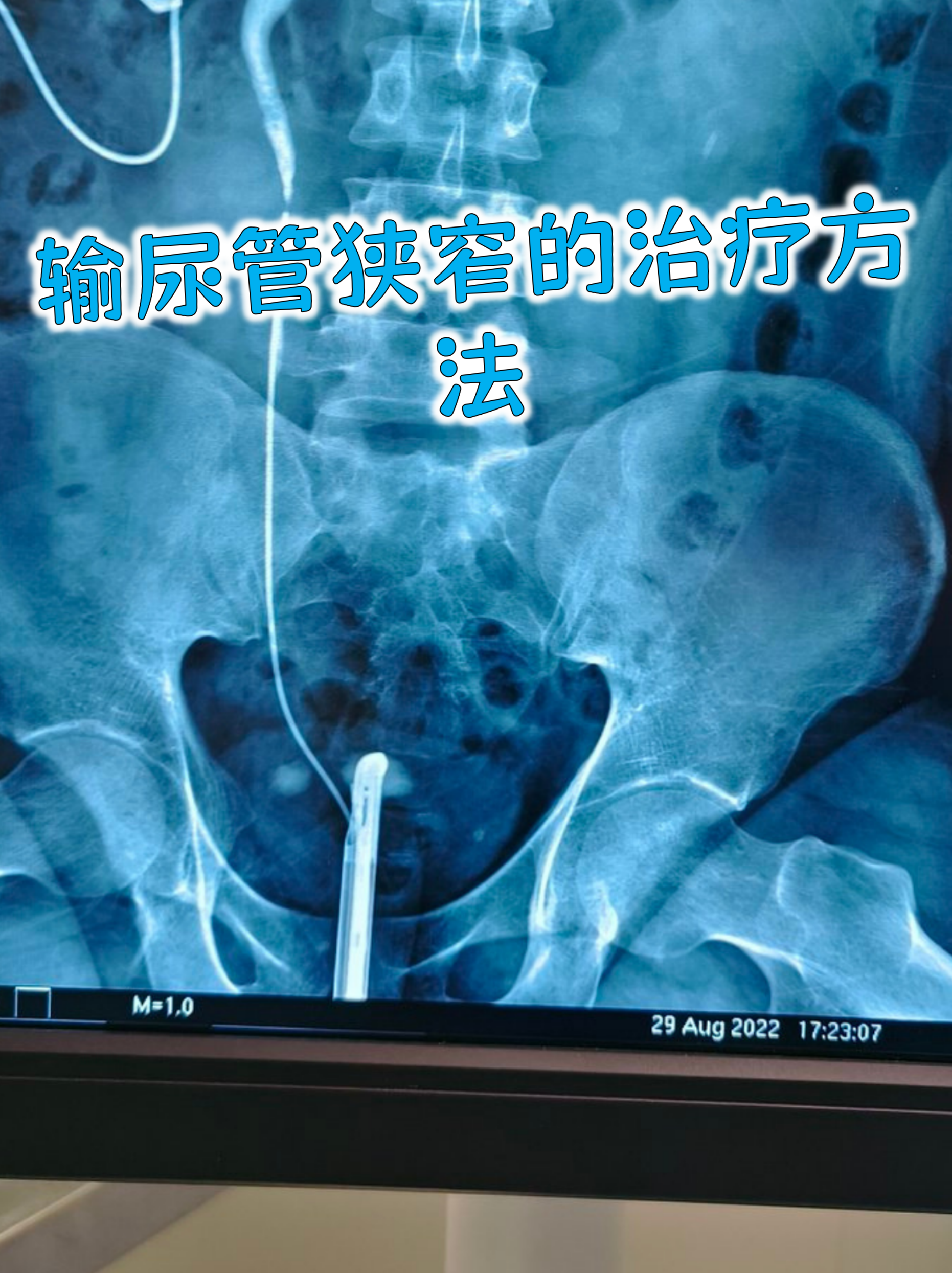 输尿管狭窄的治疗方法