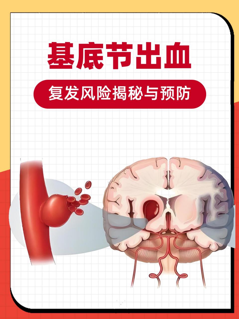 基底节出血:复发风险揭秘与预防[挠头] 在脑健康的领域里,基底节出血