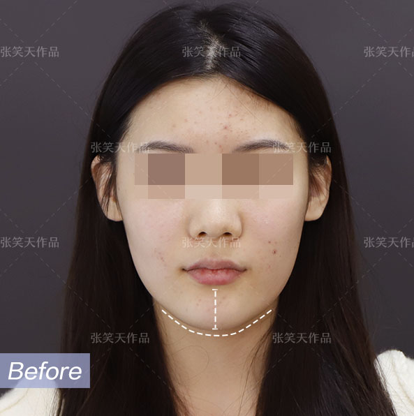 今天的案例姑娘,典型的长方脸,下巴宽长,手术切她只是意识到下颌角有