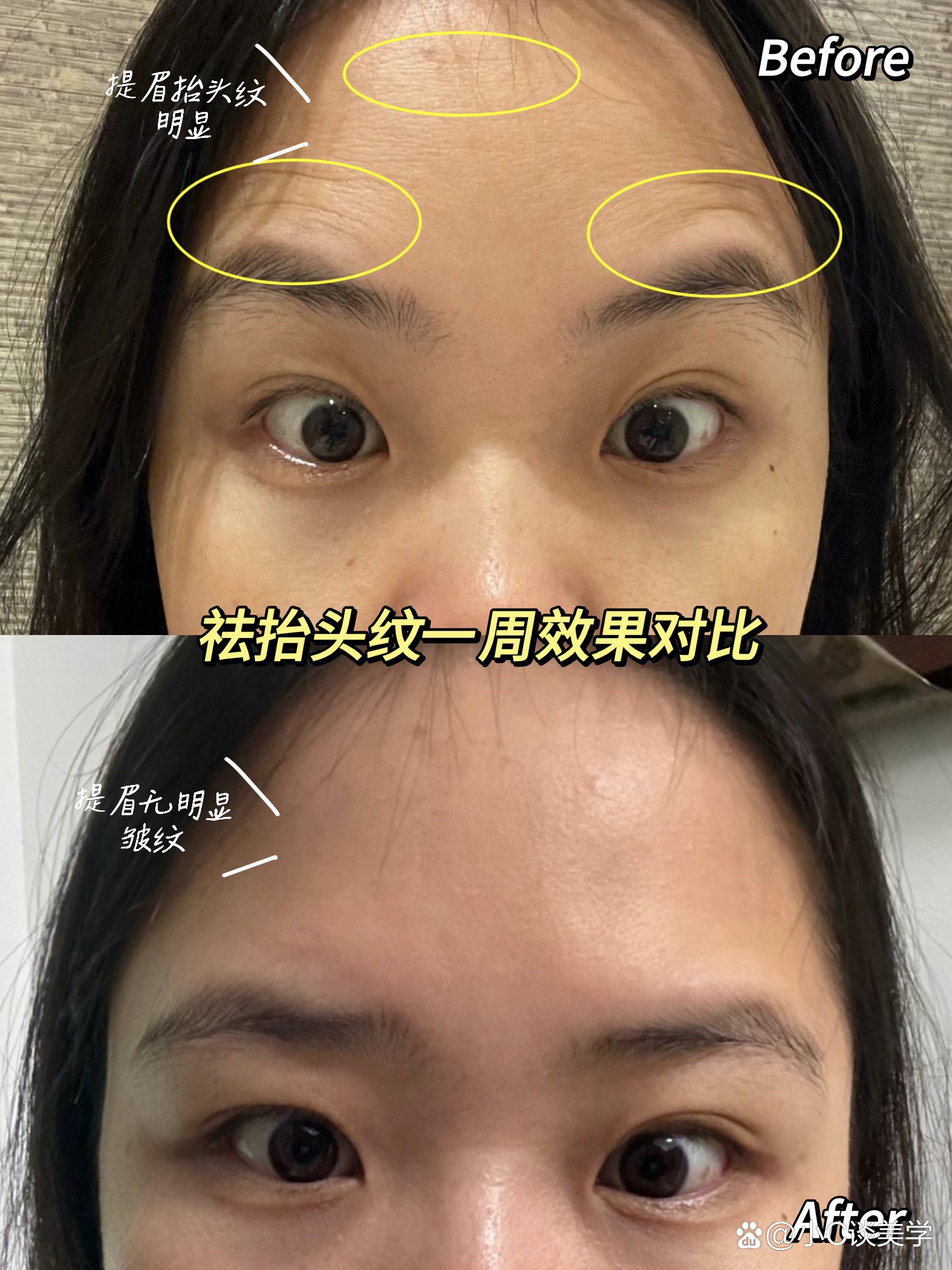 一般来说,如果抬头纹不是特别明显,局部皱纹较少,需要注射的药物较少