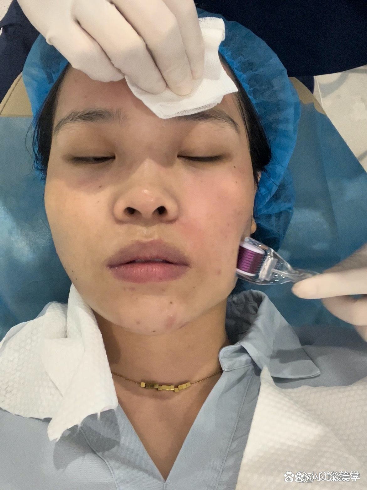 水光针和除皱针一般不建议一起打.