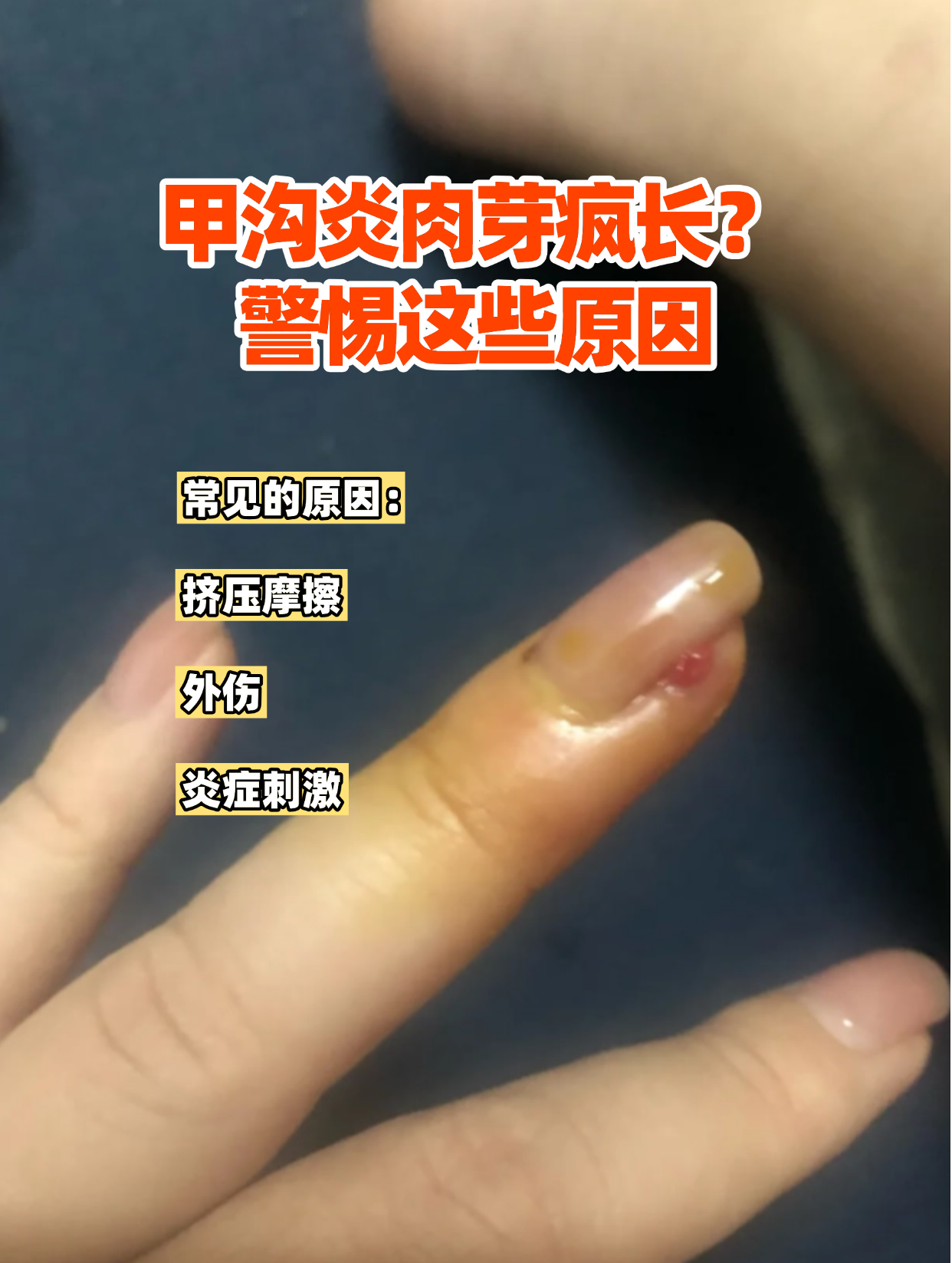 大脚趾甲缝红肿流脓,边缘长出米粒大的粉红色肉芽?