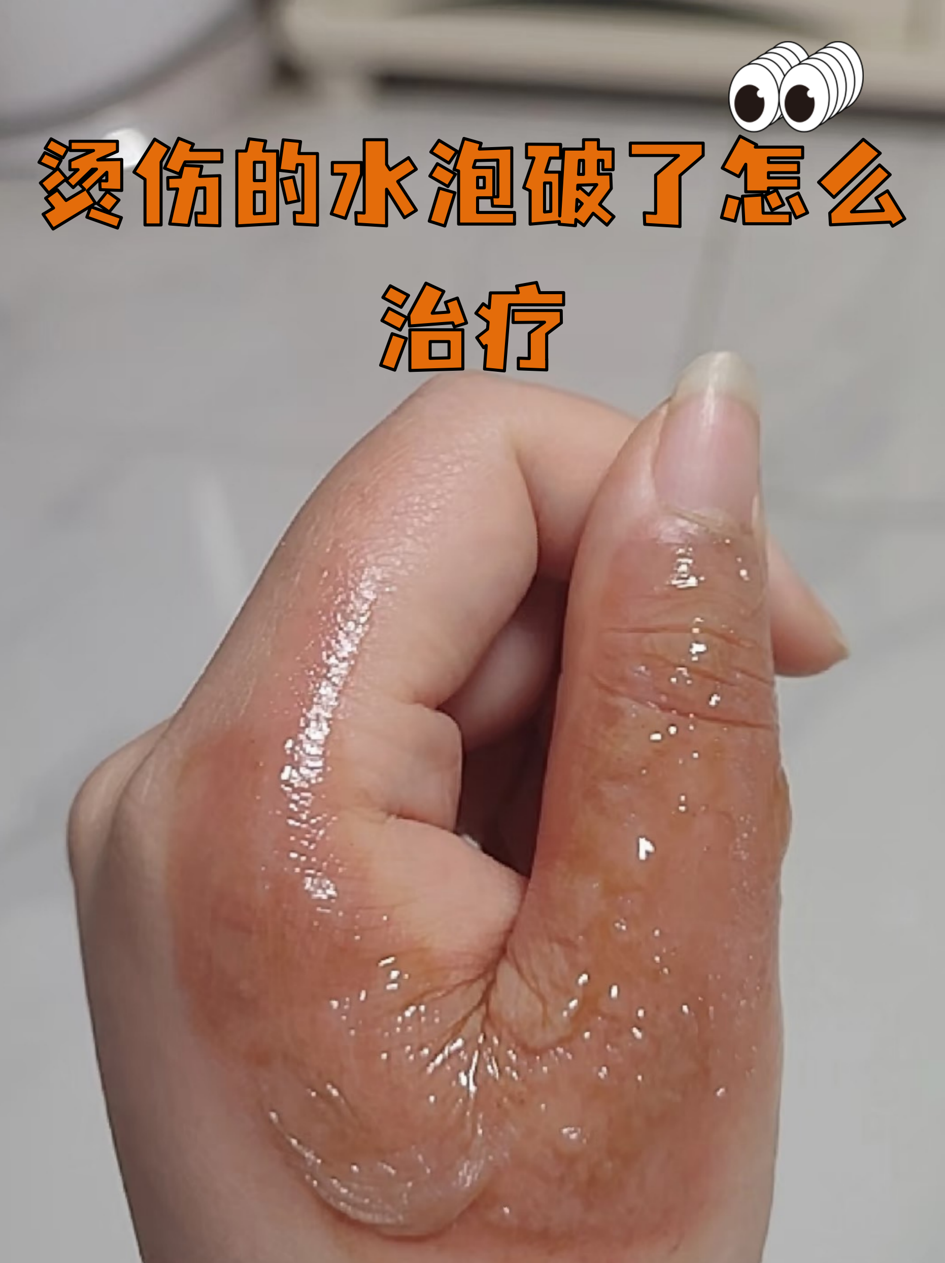 烫伤的水泡破了怎么治疗