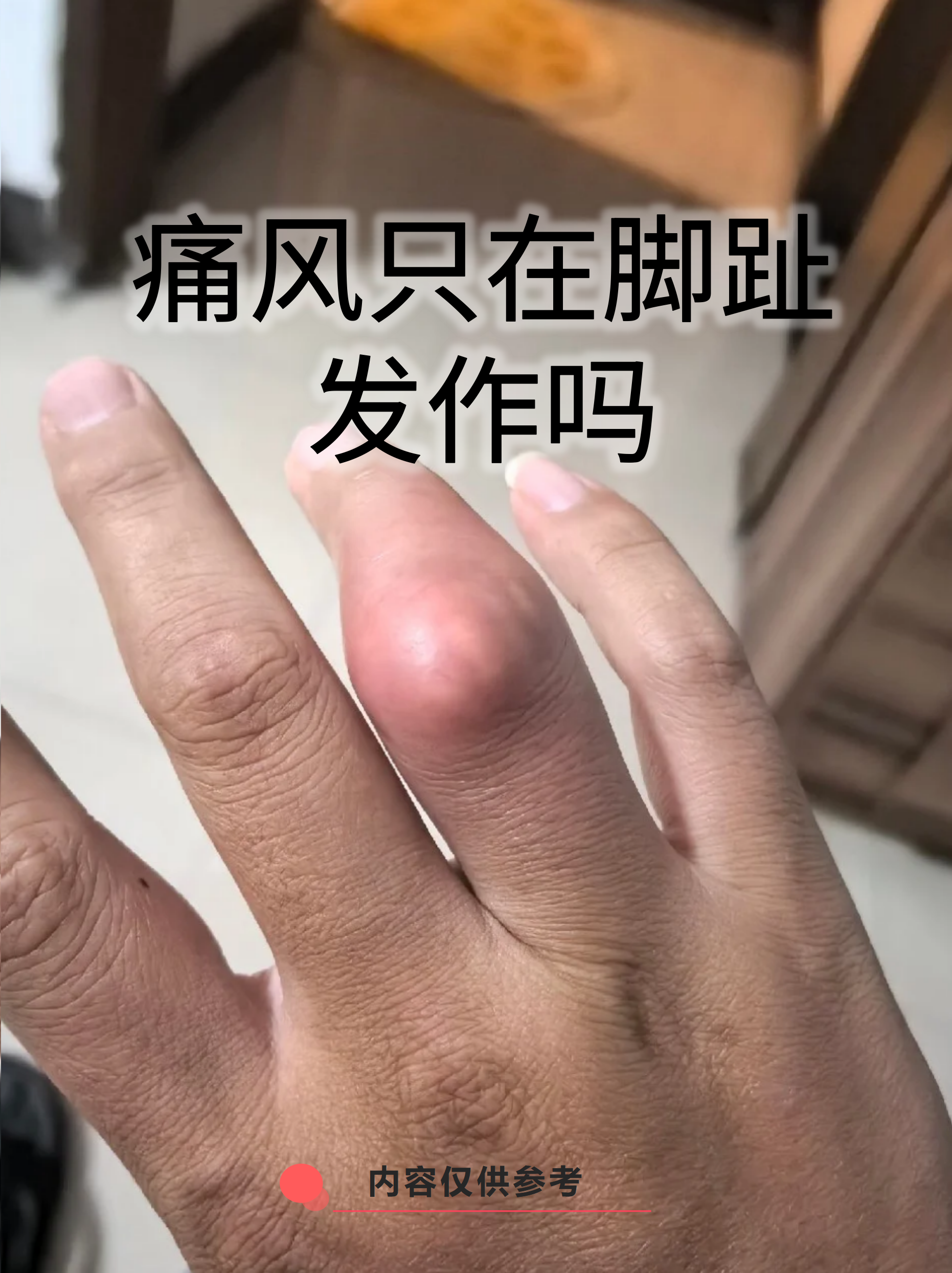 今天我们就来揭秘痛风发作的真实地图,帮你更全面认识这个"疼痛刺客"