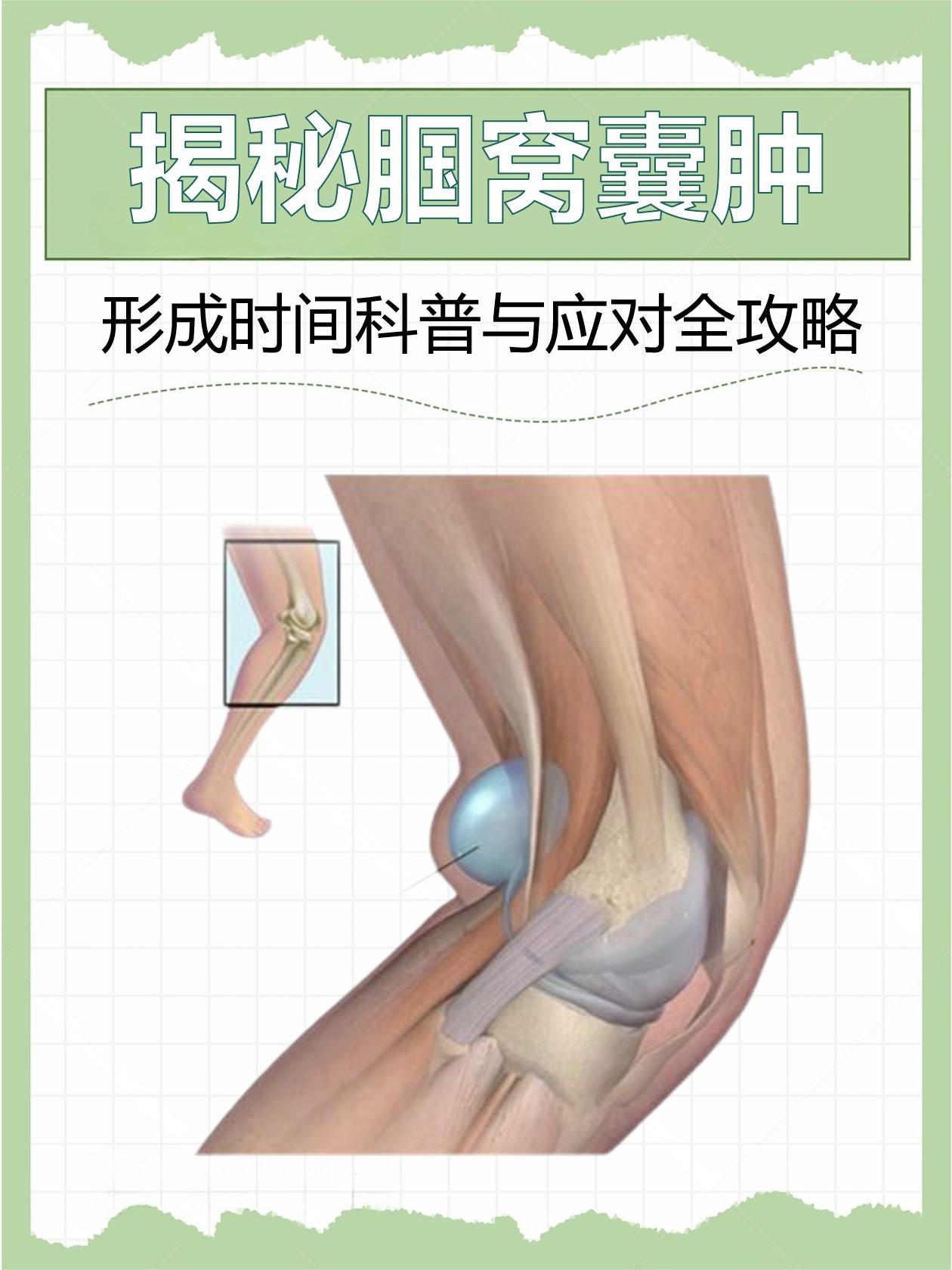 腘窝囊肿手术切口图图片