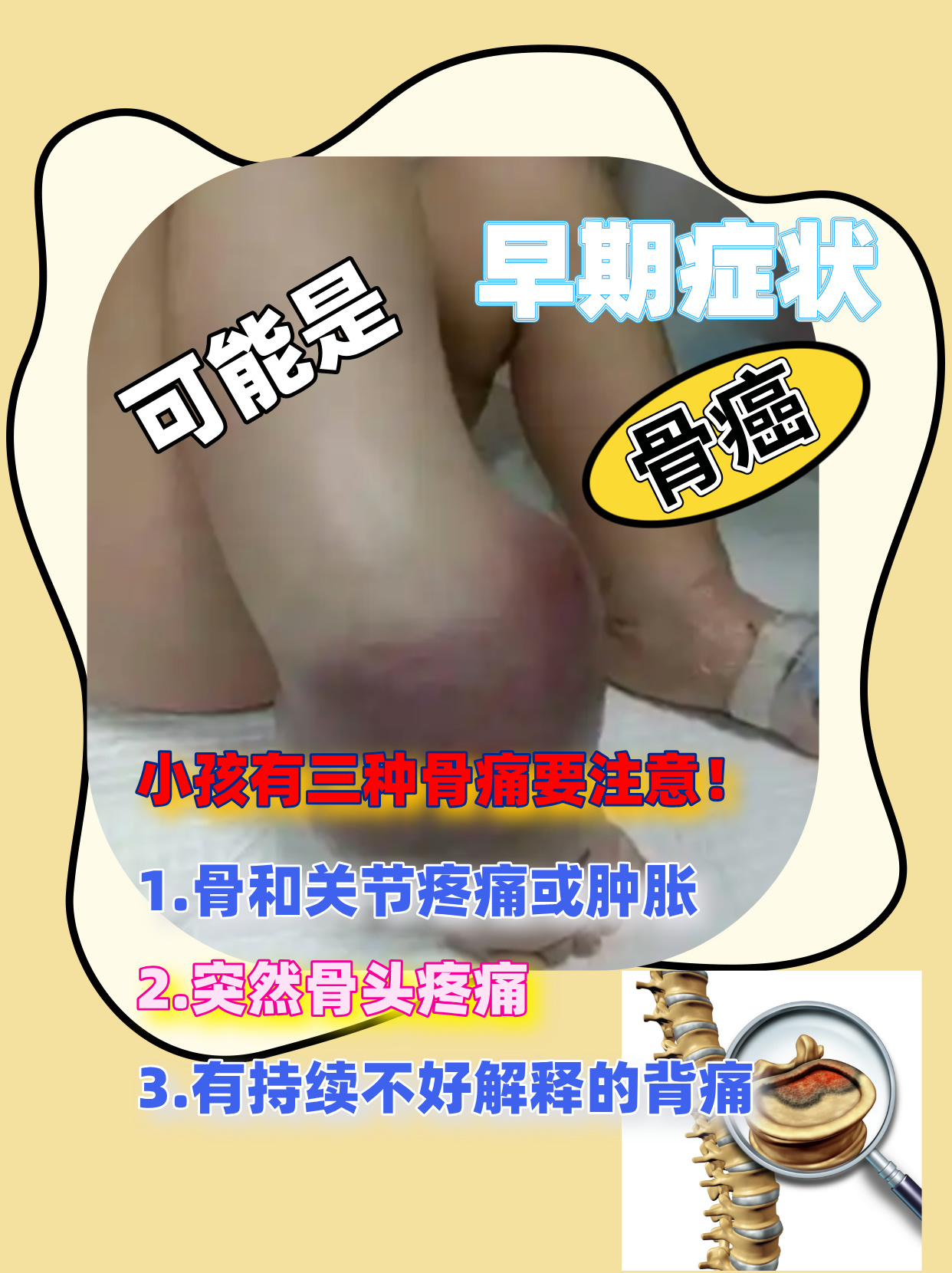 小孩有三种骨痛要注意!