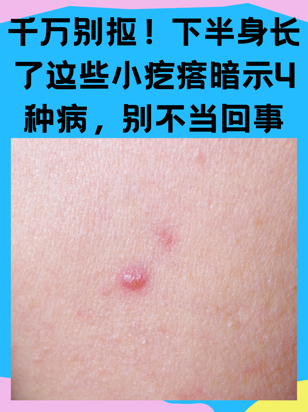 下半身长了这些小疙瘩,或暗示4种病,别不当回事